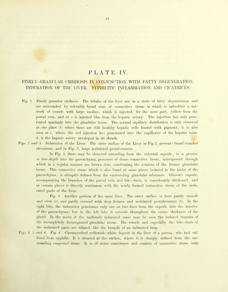 PLATE lY. FINELY-GRANUI.AR CIRRHOSIS IN CONJUNCTION WITH FATTY DEGENERATION. INDURATION OF THE LIVER. SYPHILITIC INFLAMMATION AND CICATRICES. Fig. 1. Finely gi-anular cirrhosis. The lobules of the liver are in a state of fatty degeneration and are surroimded by tolerably broad rims of connective tissue in which is imbedded a net- work of vessels with large meshes, which is injected, for the most part, yellow from the portal vein, and at a is injected blue from the hepatic artery. The injection has only pene- trated sparingly into the glandular tissue. The normal capillary distribution is only observed at one place (b) where there are still healthy hepatic cells loaded with pigment; it is also seen at c, where the red injection has penetrated into the capillaries of the hepatic veins. d, is the hepatic artery enveloped in its sheath. Figs. 2 and 3. Induration of the Liver. The outer surface of the Liver in Fig. 2, presents broad rounded elevations, and in Fig. 8, large nodulated protuberances. In Fig. 2, there may be observed extending from the external capsule, to a greater or less depth into the parenchyma, processes of dense connective tissue, interspersed through which in a regular manner are brown dots, constituting the remains of the former glandular tis.sue. This connective tissue which is also found at same places isolated in the midst of the parenchyma, is abruptly defined from the surrounding glandMar substance. Glisson's capsule, accompanying the branches of the portal vein and bile-ducts, is considerably thickened, and at certain places is directly continuous with the newly formed connective tissue of the indu- rated parts of the liver. Fig. 3. Anothei' portion of the same liver. The outer surface is here partly smooth and even (<r), and partly covered with deep fissures and nodulated protuberances (b). In the right lobe, the induration penetrates only one or two lines from the capsule into the interior of the parenchyma; but hi the left lobe it extends throughout the entire thickness of the gland. In the midst of the uniformlj^ indurated mass may be seen the isolated remains of the incompletely disintegrated glandular tissue. The vessels and especially the bile-ducts of the indurated parts are dilated, like the bronchi of an indurated lung. Figs. 4, 5 and G. Fig. 4. Circumscribed yellowish - white depo.sit in the liver of a person, who had .suf- fered from syphilis. It is situated at the surface, where it is sharply defined fi’om the sur- rounding congested tissue. It is of dense consistence and consists of connective tis.sue with