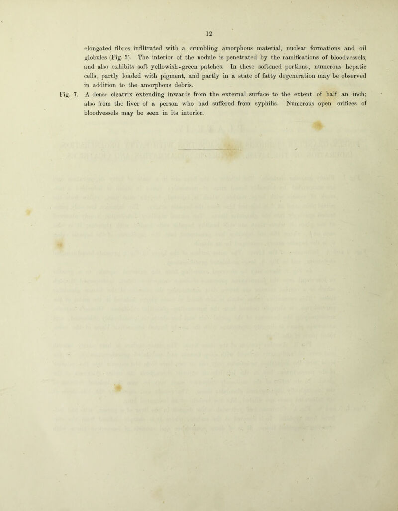 elongated fibres infiltrated with a crumbling amorphous material, nuclear formations and oil globules (Fig. 5). The interior of the nodule is penetrated by the ramifications of bloodvessels, and also exhibits soft yellowish-green patches. In these softened portions, numerous hepatic cells, {)artly loaded with pigment, and partly in a state of fatty degeneration may be observed in addition to the amorphous debris. Fig. 7. A dense cicatrix extending inwards from the external surface to the extent of half an inch; also from the liver of a person who had suffered from syphilis. Numerous open oi’ifices of bloodvessels may be seen in its interior.