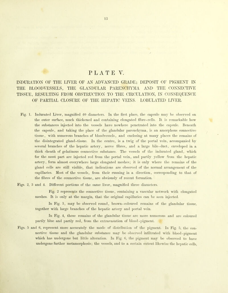 1 o 1 o / PLATE V. INDURATION OF THE LIVER OF AN ADVANCED GRADE; DEPOSIT OF PIGMENT IN THE BLOODVESSELS, THE GLANDULAR PARENCHALMA AND THE CONNECTIVE TISSUE, RESULTING FROM OBSTRUCTION TO THE CIRCULATION, IN CONSEQUENCE OF PARTIAL CLOSURE OF THE HEPATIC VEINS. LOBULATED LIVER. Fig. 1. Indurated Liver, magnified 40 diameters. In the first place, the capsule may be observed on the outer surface, much thickened and containing elongated fibre-cells. It is remarkable how the substances injected into the vessels have nowhere penetrated into the capsule. Beneath the capsule, and taking the place of the glandular parench}mia, is an amorphous connective tissue, with numerous branches of bloodvessels, and enclosing at many places the remains of the disintegrated gland - tissue. In the centre, is a twig of the portal vein, accompanied by several branches of the hepatic artery, nerve fibres, and a large bile-duct, enveloped in a thick sheath of gelatinous connective substance. The vessels of the indurated gland, which for the most part are injected red from the portal vein, and partly yellow from the hepatic artery, form almost everywhere large elongated meshes; it is only where the remains of the gland cells are still visible, that indications are observed of the normal arrangement of the capillaries. Most of the vessels, from their running in a direction, corre.sponding to that of the fibres of the connective tissue, are obviously of recent formation. Figs. 2, 3 and 4. Different portions of the same liver, magnified three diameters. Fig. 2 represents the connective tissue, containing a vascular network with elongated meshes. It is only at the margin, that the original capillaries can be seen injected. In Fig. 3, may be observed round, brown - coloured remains of the glandular tissue, together with large branches of the hepatic artery and portal vein. In Fig. 4, these remains of the glandular tissue are more numerous and are coloured partly blue and partly red, from the extravasation of blood-pigment. Figs. 5 and 6, represent more accurately tlie mode of distribution of the pigment. In Fig. 5, the con- nective tissue and the glandular substance may be observed infiltrated witli blood-pigment which has undergone but little alteration. In Fig. G, the pigment may be observed to have undergone further metamorphosis; the vessels, and to a certain extent likewise the hepatic cells.