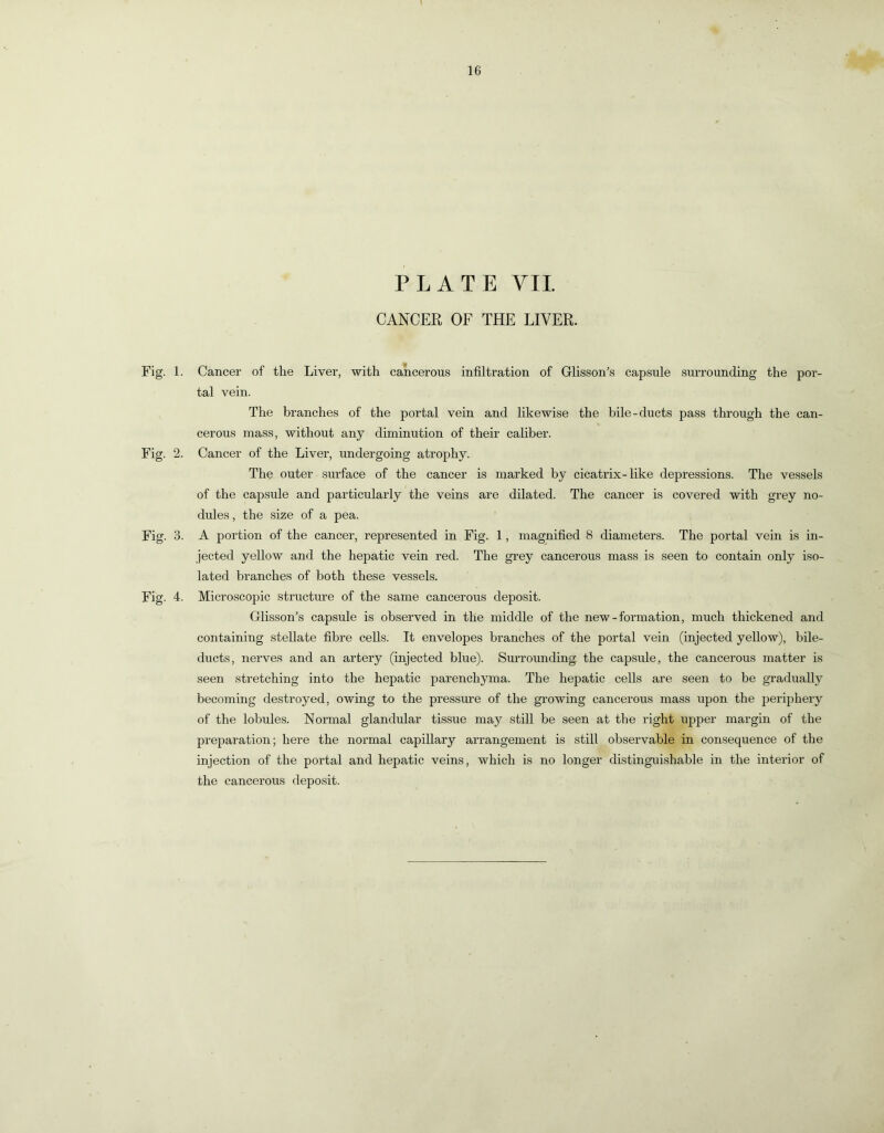 PLATE YIL CANCER OF THE LIVER. Fig. 1. Cancer of the Liver, with cancerous infiltration of Glisson’s capsule surrounding the por- tal vein. The branches of the portal vein and likewise the bile-ducts pass through the can- cerous mass, without any diminution of their caliber. Fig. 2. Cancer of the Liver, undergoing atrophy. The outer surface of the cancer is marked by cicatrix-like depressions. The vessels of the capsule and particularly the veins are dilated. The cancer is covered with grey no- dules , the size of a pea. Fig. 3. A portion of the cancer, represented in Fig. 1, magnified 8 diameters. The portal vein is in- jected yellow and the hepatic vein red. The grey cancerous mass is seen to contain only iso- lated branches of both these vessels. Fig. 4. Microscopic structure of the same cancerous deposit. Glisson’s capsule is observed in the middle of the new-formation, much thickened and containing stellate fibre cells. It envelopes branches of the portal vein (injected yellow), bile- ducts, nerves and an artery (injected blue). Surrounding the capsule, the cancerous matter is seen stretching into the hepatic parenchyma. The hepatic cells are seen to be gradually becoming destroyed, owing to the pressure of the growing cancerous mass upon the periphery of the lobules. Normal glandular tissue may still be seen at the right upper margin of the preparation; here the normal capillary arrangement is still observable in consequence of the injection of the portal and hepatic veins, which is no longer distinguishable in the interior of the cancerous deposit.