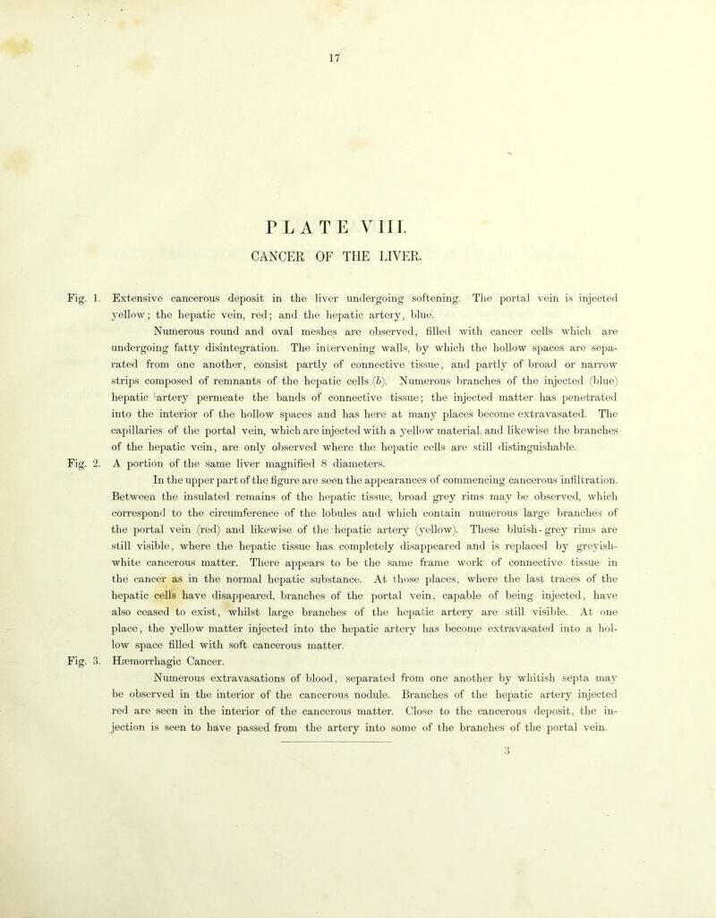 PLATE YIIL CANCER OF THE LIVER. Fig. 1. Extensive cancerous deposit in the liver undergoing softening. The portal vein is injected yellow; the hepatic vein, red; and the hepatic artery, blue. Numerous round and oval meshes are observed, filled with cancer cells which are undergoing fatty disintegration. The intervening walls, by which the hollow spaces are sepa- rated from one another, consist partly of connective tis.sue, and partly of broad or narrow strips composed of remnants of the hepatic cells (b). Numerous branches of the injected (blue) hepatic ^artery permeate the bands of connective tissue; the injected matter has penetrated into the interior of the hollow spaces and has here at many places become extravasated. The capillaries of the portal vein, which are injected with a yellow material, and likewise the branches of the hepatic vein, are only observed where the hepatic cells are still distinguishable. Fig. 2. A portion of the same liver magnified 8 diameters. In the upper part of the figure are seen the appearances of commencing cancerous infiltration. Between the insulated remains of the hepatic tissue, broad grey rims ma}^ be observed, which correspond to the circumference of the lobules and which contain numerous large branches of the portal vein (red) and likewise of the hepatic artery (yellow). These blui.sh-grey rims are still visible, where the hepatic tissue has completely disajjpeared and is replaced by gre\dsh- white cancerous matter. There appears to be the same frame work of connective tis.sue in the cancer as in the normal hepatic substance. At those places, where the last traces of the hepatic cells have disappeared, branches of the portal vein, capable of being injected, have also ceased to exist, whilst lai’ge branches of the hepatic artery are still visible. At one place, the yellow matter injected into the hepatic artery has become extravasated into a hol- low space filled with soft cancerous matter. Fig. 3. Hfemorrhagic Cancer. Numerous extravasations of blood, separated from one another by whitish septa may be observed in the interior of the cancerous nodule. Branches of the hepatic artery injected red are seen in the interior of the cancerous matter. Close to the cancerous deposit, the in- jection is seen to have passed from the artery into some of the branches of the portal vein.