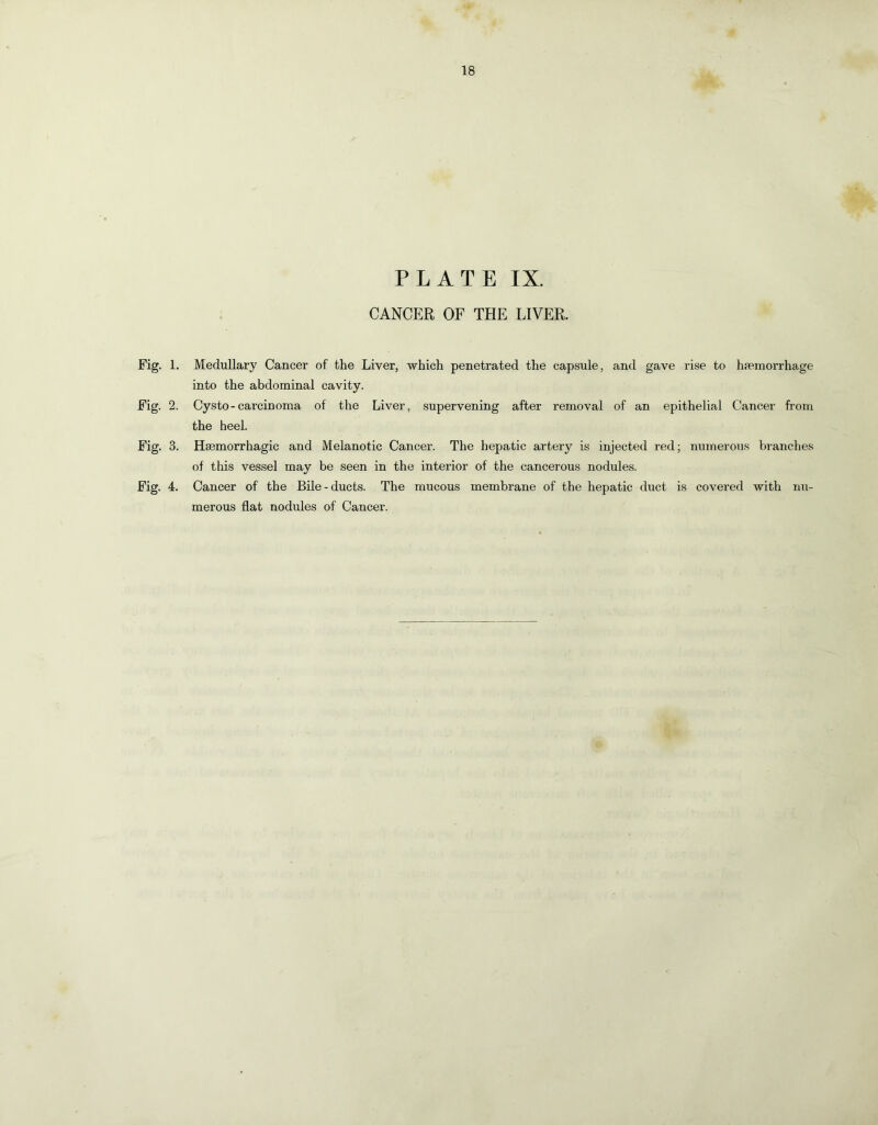PLATE IX. CANCER OF THE LIVER. Fig. 1. Medullary Cancer of the Liver, which penetrated the capsule, and gave rise to hfemorrhage into the abdominal cavity. Fig. 2. Cysto-carcinoma of the Liver, supervening after removal of an epithelial Cancer from the heel. Fig. 3. Haemorrhagic and Melanotic Cancer. The hepatic artery is injected red; numerous branches of this vessel may be seen in the interior of the cancerous nodules. Fig. 4. Cancer of the Bile-ducts. The mucous membrane of the hepatic duct is covered with nu- merous flat nodules of Cancer.