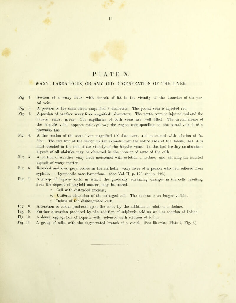 PLATE X. WAXY, LARDACEOUS, OR AMYLOID DEGENERATION OF THE LIVER. Fig. 1. Section of a waxy liver, with deposit of fat in the vicinity of the branches of the por- tal vein. Fig. 2. A portion of the same liver, magnified 8 diameters. The portal vein is injected red. Fig. 3. A portion of another waxy liver magnified 8 diameters. The portal vein is injected red and the hepatic veins, green. The capillaries of both veins are well filled The circumference of the hepatic veins appears pale-yellow; the region corresponding to the portal vein is of a brownish hue. Fig. 4. A fine section of the same liver magnified 150 diameters, and moistened with solution of Io- dine. The red tint of the waxy matter extends over the entire area of the lobule, but it is most decided in the immediate vicinity of the hepatic veins. In this last locality an abundant depo.sit of oil globules may be observed in the interior of some of the cells. Fig. 5. A portion of another waxy liver moistened with solution of Iodine, and showing an isolated deposit of waxy matter. Fig. 6. Rounded and oval gi’ey bodies in the cirrhotic, waxy liver of a person who had suffered from syphilis. — Lymphatic new-formations. (See Vol. II, p. 173 and p. 222.) Fig. 7. A group of hepatic cells, in which the gi’adually advancing changes in the cells, resulting from the deposit of amyloid matter, may be traced. a. Cell with distended nucleus; b. Uniform distention of the enlarged cell. The nucleus is no longer visible; c. Debris of I'he disintegrated cells. Fig. 8. Alteration of colour produced upon the cells, by the addition of solution of Iodine. Fig. 9. Further alteration produced by the addition of sulphiiric acid as well as solution of Iodine. Fig. 10. A dense aggregation of hepatic cells, coloured with solution of Iodine. Fig. 11. A group of cells, with the degenerated branch of a vessel. (See likewise, Plate I, Fig. 3.)
