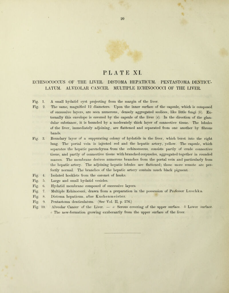 PLATE XI ECHmOCOCCUS OF THE LIVER. DISTOMA HEPATICUM. PENTASTOMA DENTICU- LATUM. ALVEOLAR CANCER. MULTIPLE ECHINOCOCCI OF THE LIVER. Fig. 1. Fig. 2. Fig. 3. Fig. 4. Fig. 5. Fig. G. Fig. 7. Fig. 8. Fig. 9. Fig. 10. A small hydatid cyst projecting from the margin of the liver. The same, magnified 12 diameters. Upon the inner surface of the capsule, which is composed of successive layers, are seen numerous, densely aggregated scolices, like little fungi (6). Ex- ternally this envelope is covered by the capsule of the liver (c). In the direction of the glan- dular substance, it is bounded by a moderately thick layer of connective tissue. The lobules of the liver, immediately adjoining, are fiattened and separated from one another by fibrous bands. Boundary layer of a suppurating colony of hydatids in the liver, which burst into the riglit lung. The portal vein is injected red and the hepatic artery, yellow. The cap.sule, which separates the hepatic parenchyma from the echinococcus, consists partly of crude connective tis.sue, and partly of connective tissue with branched corpuscles, aggregated together in rounded masses. The membrane derives numerous branches from the portal vein and particularly from the hepatic artery. The adjoining hepatic lobules are fiattened; those more remote are per- fectly normal. The branches of the hepatic artery contain much black pigment. Isolated booklets from the coronet of hooks. Large and small hydatid vesicles. Hydatid membrane composed of successive layers. Multiple Echinococci, drawn from a preparation in the possession of Professor Luschka. Distoma hepaticum, after Kuchenmeister. Pentastoma denticulatum. (See Vol. II, p. 276.) Alveolar Cancer of the Liver. — a Serous covering of the upper suiTace. Lower .surface. <• The new-formation growing exuberantly from the upper surface of the liver.