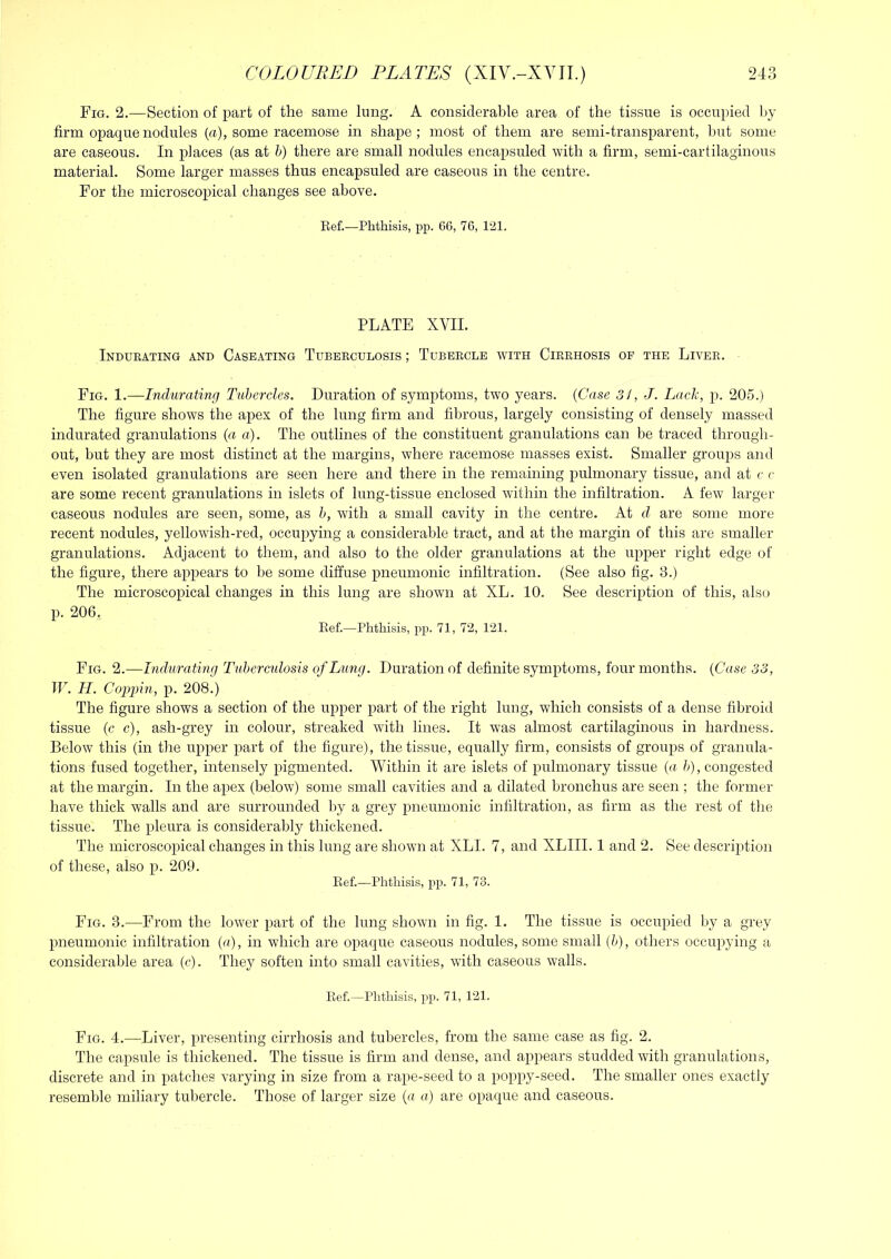 Fig. 2.—Section of part of the same lung. A considerable area of the tissue is occupied l)y firm opaque nodules («), some racemose in shape; most of them are semi-transparent, but some are caseous. In places (as at h) there are small nodules encapsuled with a firm, semi-cartilaginous material. Some larger masses thus encapsuled are caseous in the centre. For the microscopical changes see above. Eef.—Phthisis, pp. 6G, 76, 121. PLATE XVII. Indueating and Caseating Tubeeculosis ; Tubeecle with Cieehosis op the Livee. Fig. 1.—Indurating Tubercles. Duration of symptoms, two years. (Case 3/, J. Lack, p. 205.) The figure shows the apex of the lung firm and fibrous, largely consisting of densely massed indurated granulations (a a). The outlines of the constituent granulations can be traced through- out, but they are most distinct at the margins, where racemose masses exist. Smaller groups and even isolated granulations are seen here and there in the remaining pulmonary tissue, and at c r are some recent granulations in islets of lung-tissue enclosed within the infiltration. A few larger caseous nodules are seen, some, as h, with a small cavity in the centre. At d are some more recent nodules, yellowish-red, occupying a considerable tract, and at the margin of this are smaller granulations. Adjacent to them, and also to the older granulations at the upper right edge of the figure, there appears to be some diffuse pneumonic infiltration. (See also fig. 8.) The microscopical changes in this lung are shown at XL. 10. See description of this, also p. 206. Ref.—Phthisis, pp. 71, 72, 121. Fig. 2.—Indurating TubercidosisofLung. Duration of definite symptoms, four months. {Case 33, TF. H. Coppin, p. 208.) The figure shows a section of the upper part of the right lung, which consists of a dense fibroid tissue (c c), ash-grey in colour, streaked with lines. It was almost cartilaginous in hardness. Below this (in the upper part of the figure), the tissue, equally firm, consists of groups of granula- tions fused together, intensely pigmented. Within it are islets of pulmonary tissue {a h), congested at the margin. In the apex (below) some small cavities and a dilated bronchus are seen ; the former have thick walls and are surrounded by a grey pneumonic infiltration, as firm as the rest of the tissue. The pleura is considerably thickened. The microscopical changes in this lung are shown at XLI. 7, and XLIII. 1 and 2. See description of these, also p. 209. Eef.—Phthisis, pp. 71, 73. Fig. 3.—^From the lower part of the lung shown in fig. 1. The tissue is occupied by a grey pneumonic infiltration {a), in which are opaque caseous nodules, some small {h), others occupying a considerable area (c). They soften into small cavities, with caseous walls. Eef.—Phthisis, pp. 71, 121. Fig. 4.—^Liver, presenting cirrhosis and tubercles, from the same case as fig. 2. The capsule is thickened. The tissue is firm and dense, and appears studded with granulations, discrete and in patches varying in size from a rape-seed to a poppy-seed. The smaller ones exactly resemble miliary tubercle. Those of larger size {a a) are opaque and caseous.