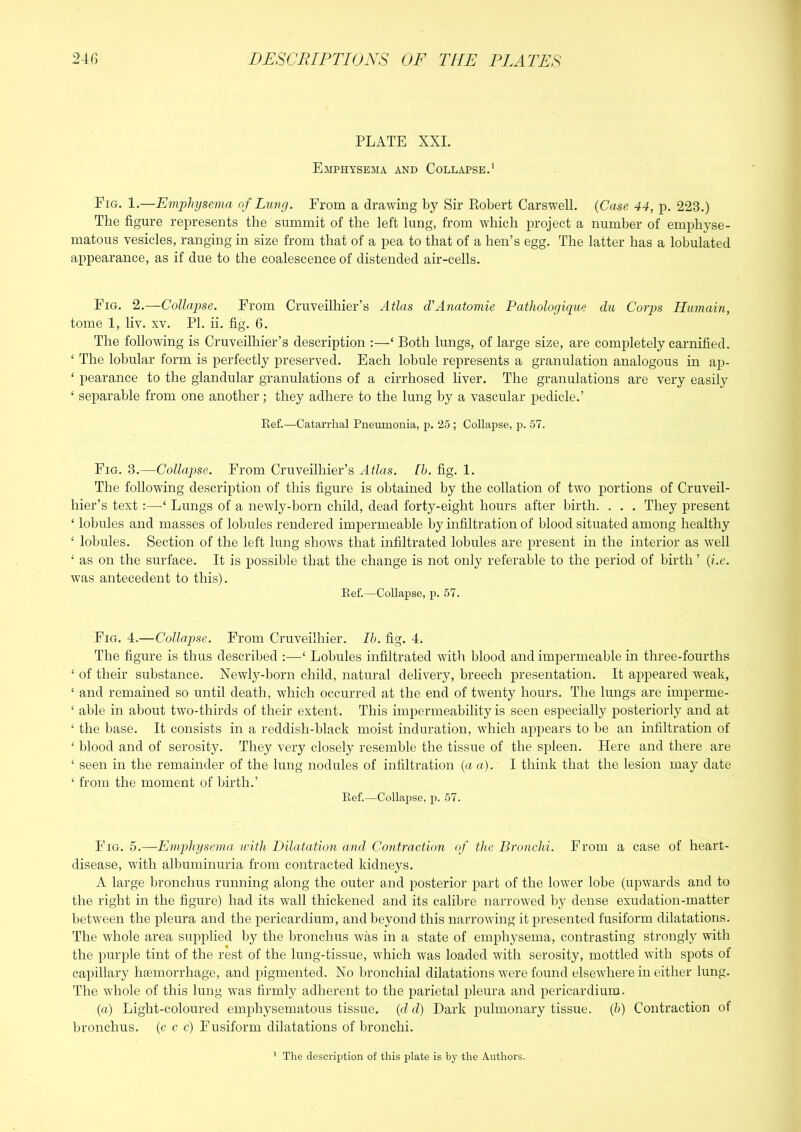 PLATE XXI. Emphysema and Collapse.* Fig. 1.—Emphysema of Lung. From a drawing by Sir Piobert Carswell. {Case 44, p. 223.) The figure represents the summit of the left lung, from which jH’oject a number of emphyse- matous vesicles, ranging in size from that of a iiea to that of a hen’s egg. The latter has a lobulated appearance, as if due to the coalescence of distended air-cells. Fig. 2.—Collapse. From Cruveilhier’s Atlas d’Anatomie Pathologique da Corps Humain, tome 1, liv. xv. PI. ii. fig. 6. The following is Cruveilhier’s description :—‘ Both lungs, of large size, are completely carnified. ‘ The lobular form is perfectly preserved. Each lobule represents a granulation analogous in ap- ‘ pearance to the glandular granulations of a cirrhosed liver. The granulations are very easily ‘ separable from one another; they adhere to the lung by a vascular pedicle.’ Eef.—Catarrhal Pneumonia, p. 25; Collapse, p. 57. Fig. 3.—Collapse. From Cruveilhier’s Atlas. Ih. fig. 1. The following description of this figure is obtained by the collation of two portions of Cruveil- hier’s text :—‘ Lungs of a newly-born child, dead forty-eight hours after birth. . . . They present ‘ lobules and masses of lobules rendered impermeable by infiltration of blood situated among healthy ‘ lobules. Section of the left lung shows that infiltrated lobules are present in the interior as well ‘ as on the surface. It is possible that the change is not only referable to the period of birth ’ {i.e. was antecedent to this). Eef.—Collapse, p. 57. Fig. 4.—Collapse. From Cruveilhier. Ih. fig. 4. The figure is thus described :—‘ Lobules infiltrated with blood and impermeable in three-fourths ‘ of their substance. Newly-born child, natural delivery, breech presentation. It appeared weak, ‘ and remained so until death, which occurred at the end of twenty hours. The lungs are imperme- ‘ able in aliout two-thirds of their extent. This impermeability is seen especially posteriorly and at ‘ the base. It consists in a reddish-black moist induration, which appears to be an infiltration of ‘ blood and of serosity. They very closely resemble the tissue of the spleen. Here and there are ‘ seen in the remainder of the lung nodules of infiltration {a a). I think that the lesion may date ‘ from the moment of birth.’ Eef.—Collapse, p. 57. Fig. 5.—Emphysema with Dilatation and Contraction of the Bronchi. From a case of heart- disease, with albuminuria from contracted kidneys. A large bronchus running along the outer and jiosterior part of the lower lobe (upwards and to the right in the figure) had its w'all thickened and its calibre narrowed by dense exudation-matter lietween the pleura and the pericardium, and beyond this narrowing it presented fusiform dilatations. The whole area supplied by the bronchus was in a state of emphysema, contrasting strongly with the purple tint of the rest of the lung-tissue, which was loaded with serosity, mottled with spots of capillary hiemorrhage, and pigmented. No bronchial dilatations w'ere found elsewhere in either lung. The whole of this lung was firmly adherent to the parietal pleura and pericardium. (rt) Light-coloured emphysematous tissue, {d d) Dark pulmonary tissue, f) Contraction ot bronchus, (c c c) Fusiform dilatations of bronchi. ‘ The description of this plate is by the Authors.
