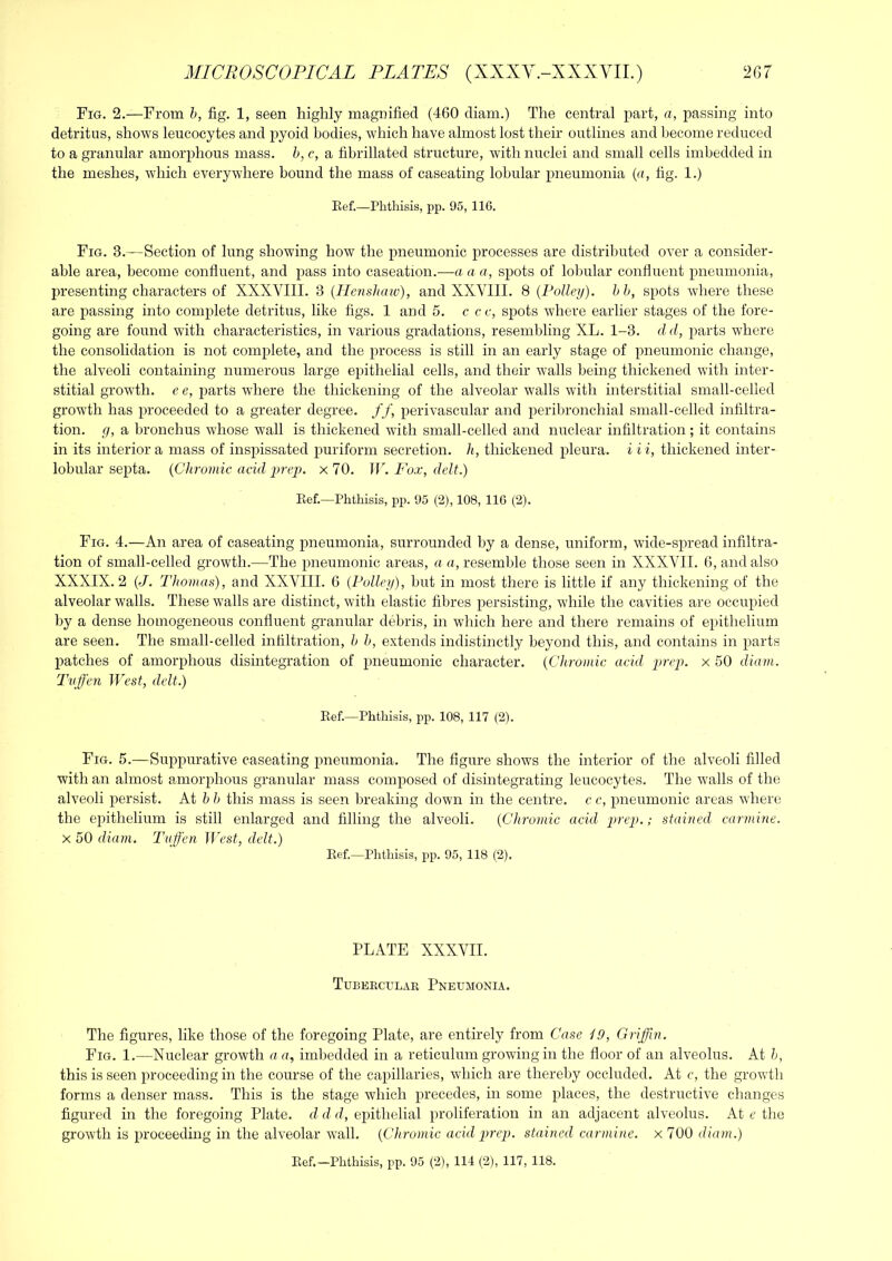 Fig. 2.—From h, fig. 1, seen highly magnified (460 diam.) The central part, a, passing into detritus, shows leucocytes and pyoid bodies, which have almost lost their outlines and become reduced to a granular amorphous mass, h, c, a fibrillated structure, with nuclei and small cells imbedded in the meshes, which everywhere bound the mass of caseating lobular pneumonia {a, fig. 1.) Eef.—Phthisis, pp. 95, 116. Fig. 3.—Section of lung showing how the pneumonic processes are distributed over a consider- able area, become confluent, and pass into caseation.—a a a, spots of lobular confluent pneumonia, presenting characters of XXXVIII. 3 (Ilenshaw), and XXVIII. 8 (Polley). hh, spots where these are passing into complete detritus, like figs. 1 and 5. c cc, spots where earlier stages of the fore- going are found with characteristics, in various gradations, resembling XL. 1-3. dd, parts where the consolidation is not complete, and the process is still in an early stage of pneumonic change, the alveoli containing numerous large epithelial cells, and their walls being thickened with inter- stitial growth, e e, jiarts where the thickening of the alveolar walls with interstitial small-celled growth has proceeded to a greater degree. //, perivascular and peribronchial small-celled infiltra- tion. g, a bronchus whose wall is thickened with small-celled and nuclear infiltration; it contains in its interior a mass of insjiissated puriform secretion, h, thickened pleura, i ii, thickened inter- lobular septa. {Chromic acid prep. x 70. W. Fox, deli.) Ref.—Phthisis, pp. 95 (2), 108, 116 (2). Fig. 4.—An area of caseating pneumonia, surrounded by a dense, uniform, wide-spread infiltra- tion of small-celled growth.—The pneumonic areas, a a, resemble those seen in XXXVII. 6, and also XXXIX. 2 {J. Thomas), and XXVIII. 6 {Polleg), but in most there is little if any thickening of the alveolar walls. These walls are distinct, with elastic fibres persisting, while the cavities are occupied by a dense homogeneous confluent granular debris, in which here and there remains of epithelium are seen. The small-celled infiltration, b h, extends indistinctly beyond this, and contains in parts patches of amorphous disintegration of pneumonic character. {Chromic acid prep, x 50 diam. Tvffen West, delt.) Ref.—Phthisis, pp. 108, 117 (2). Fig. 5.—Suppurative caseating pneumonia. The figure shows the interior of the alveoli filled with an almost amorphous granular mass composed of disintegrating leucocytes. The walls of the alveoli persist. At b b this mass is seen breaking down in the centre, c c, pneumonic areas where the epithelium is still enlarged and filling the alveoli. {Chromic acid prep.; stained carmine. X 50 diam. Tnffen West, delt.) Ref.—Phthisis, pp. 95, 118 (2). PLATE XXXVII. Tubeecular Pneumonia. The figures, like those of the foregoing Plate, are entirely from Case iO, Griffin. Fig. 1.—Nuclear growth a a, imbedded in a reticulum growing in the floor of an alveolus. At b, this is seen proceeding in the course of the capillaries, which are thereby occluded. At c, the growth forms a denser mass. This is the stage which precedes, in some places, the destructive changes figured in the foregoing Plate, d d d, epithelial proliferation in an adjacent alveolus. At e the growth is proceeding in the alveolar wall. {Chromic acid prep, stained carmine, x 700 diam.)