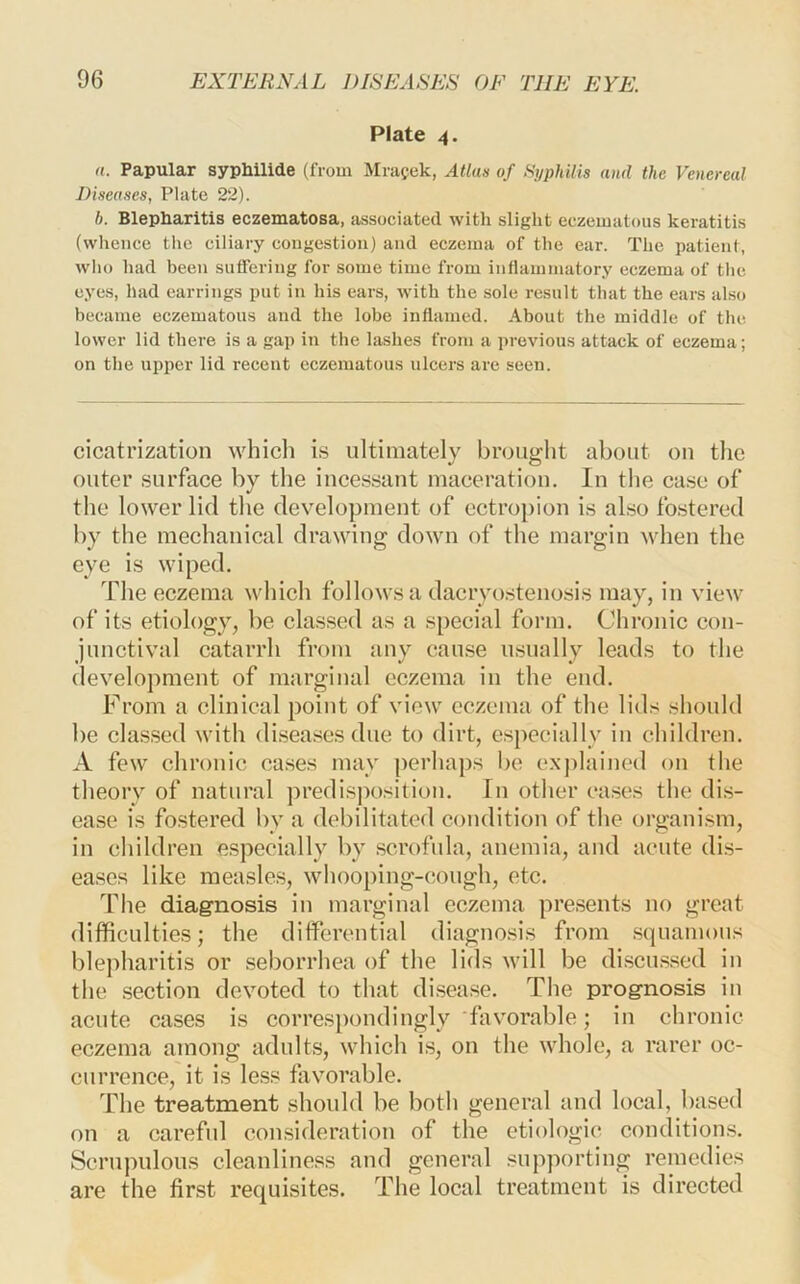 Plate 4. (t. Papular syphilide (from Mragek, Atlas of Syphilis and the Venereal Diseases, Plate 22). b. Blepharitis eczematosa, jissociated with slight eczematous keratitis (whence the ciliary congestion) and eczema of the ear. The patient, who had been suffering for soxne time from inflammatory eczema of the eyes, had earrings put in his ears, with the sole result that the ears also became eczematous and the lobe inflamed. About the middle of the lower lid there is a gap in the lashes from a previous attack of eczema; on the upper lid recent eczematous ulcers are seen. cicatrization whicli i.s ultimately brought about on the outer surface by the incessant maceration. In the case of the lower lid the development of ectropion is also fostered by the mechanical drawing down of the margin when the eye is wiped. The eczema which follows a dacryo.stenosis may, in view of its etiology, be classed as a special form. Chronic con- junctival catarrh from any cause usually leads to the development of marginal eczema in the end. From a clinical point of view eczema of the lids should be classed with diseases due to dirt, especially in children. A few chronic ca.ses may perhaps be e.\j)lained on the theory of natural predisposition. In other eases the di.s- ease is fo.stered by a debilitated condition of the organi.sm, in children especially by scrofula, anemia, and acute dis- ea.ses like measles, whooping-cough, etc. The diagnosis iii marginal eczema presents no great difficulties; the differential diagnosis from .squamous blepharitis or seborrhea of the lids will be discu.ssed in the .section devoted to that disease. The prognosis in acute cases is correspondingly 'favorable; in chronic eczema among adults, which is, on the whole, a rarer oc- currence, it is le.ss favorable. The treatment should be both general and local, based on a careful consideration of the etiologies conditions. Scrupulous cleanliness and general supporting remedies are the first requisites. The local treatment is directed