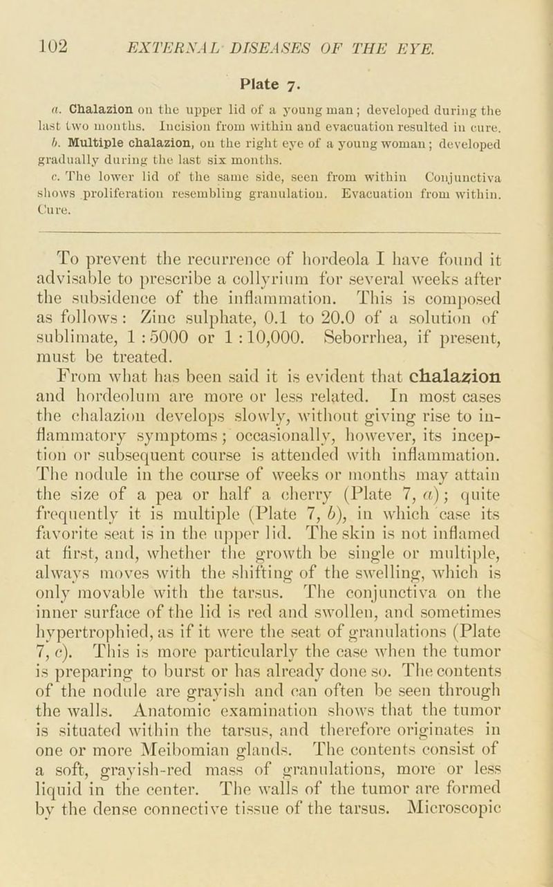 Plate 7. a. Chalazion on the upper lid of a young man; developed during the last two months. Incision from within and evacuation resulted in cure. h. Multiple chalazion, on the right eye of a young woman; developed gradually during the last six months. The lower lid of the same side, seen from within Conjunctiva shows proliferation resembling granulation. Evacuation from within. Cure. To prevent the recurrence of hordeola I have found it advisable to prescribe a collyrium for several weeks after the subsidence of the inflnnmiation. This is conipo.sed as follows : Zinc sulphate, 0.1 to 20.0 of a solution of sublimate, 1:5000 or 1:10,000. Seborrhea, if pre.sent, must be treated. From what has been .said it is evident that chalazion and hordeolum are more or le.ss related. In most cases the chalazion develops .slowly, without giving rise to in- hanimatory symptoms; occasionally, however, its incep- tion or subsequent cour.se is attended with inflammation. The nodule in the course of weeks or months may attain the size of a pea or half a cherry (Plate 7, a); (juite frequently it is multiple (Plate 7, b), in which case its favorite .seat is in the upper lid. The skin is not inflamed at first, and, whether the growth be single or mnltij)le, always moves with the shifting of the swelling, which is only movable with the tarsus. The conjunctiva on the inner surface of the lid is red and swollen, and sometimes hypertrophied, as if it were the seat of granulations (Plate 7, c). This is more particularly the case when the tumor is preparing to burst or has already done .s<c The contents of the nodule are grayish and can often be seen through the walls. Anatomic examination shows that the tumor is situated within the tarsus, and therefore originates in one or more Meibomian glands. The contents consi.st of a soft, grayish-red mass of granulations, more or less liquid in the center. The walls of the tumor are formed bv the dense connective tissue of the tarsus. Microscopic