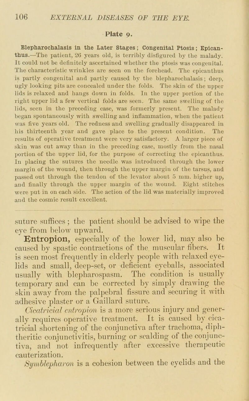 Plate 9. Blepliaroclialasia in the Later Stages; Congenital Ptosis; Epican- thus.—The patient, 26 years old, is terribly disfigured by the malady. It could not be definitely ascertained whetlier the ptosis was congenital. The characteristic wrinkles are seen on the forehead. The epiciinthus is partly congenital and partly caused by the blepharochalasis; deep, ugly looking pits are concealed under the folds. Tlie skin of the upper lids is relaxed and hangs down in folds. In the upper portion of the right upper lid a few vertical folds are seen. The same swelling of the lids, seen in the preceding case, was formerly present. The malady l)egan spontaneously with swelling and inflammation, when the patient was five years old. The redness and swelling gradually disappeared in his thirteenth year and gave place to the present condition. The results of operative treatment were very satisfactory. A larger piece of skin was cut away than in the preceding case, mostly from the nasal j)ortion of the upper lid, for the purpose of correcting the epicanthus. In placing the sutures the needle was introduced through the lower margin of the wound, then through the upper margin of the tarsus, and passed out through the tendon of the levator about 5 mm. higher up, and finally through the upper margin of the wound. Eight stitches were put in on each side. The action of the lid was materially improved and the co.smic result excellent. suture suffices ; the patient should be advised to wipe the eye from below upward. Bntropion, especially of the lower lid, may also be caused by spastic contractions of the muscular fibers. It is seen most frequently in elderly people with relaxed eye- lids and small, deep-set, or deficient eyeballs, associated usually with blepharospasm. The condition is usually temporary and can be corrected by simply drawing the skin away from the palpebral fissure and securing it with adhesive pla.ster or a Gaillard suture. Cicatricial entropion is a more serious injury and gener- ally requires operative treatment. It is caused by cica- tricial shortening of the conjunctiva after trachoma, diph- theritic conjunctivitis, burning or scalding of the conjunc- tiva, and not infrequently after exces.sivc therapeutic cauterization. Syinblepharon is a cohesion between the eyelids and the
