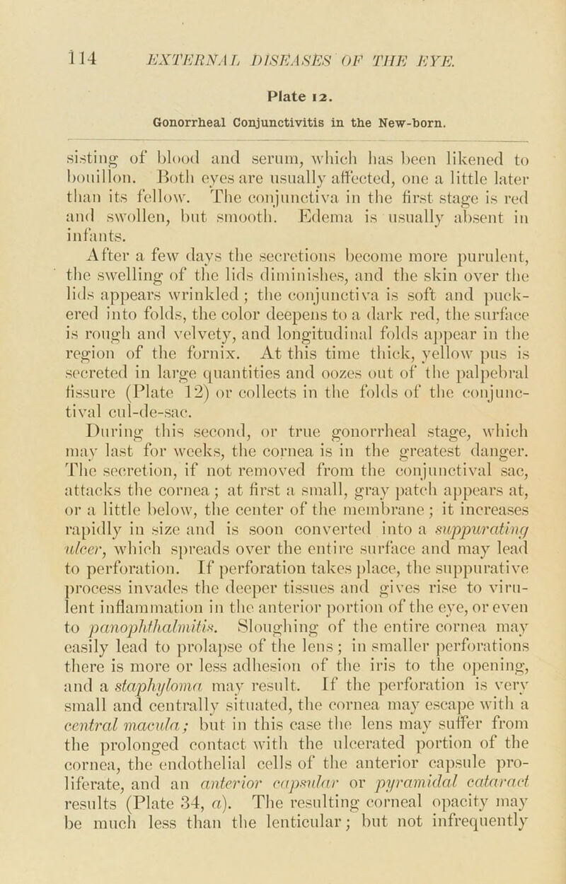 Plate 12. Gonorrheal Conjunctivitis in the New-horn. .sistiiig of blood and serum, 'which has been likened to bouillon. Jk)th eyes are usually affected, one a little later than its fellow. The conjunctiva in the first stage is red and swollen, but smooth. Edema is usually ab.sent iu infants. After a few days the secretions become more purulent, the swelling of the lids diminishes, and the skin oyer the lids appears wrinkled; the conjunctiva is .soft and ])uck- ered into folds, the color deepens to a dark red, the surface is rough and velvety, and longitudinal folds a])pear in the region of the fornix. At this time thick, yellow pus is .secreted in large quantities and oo/.es out of the palpebral fi.ssure (Plate 12) or collects in the folds of the conjunc- tiyal cnl-de-sac. Du ring this second, or true gonorrheal stage, which may last for wcek.s, the cornea is in the greatest danger. The se(!retion, if not removed from the conjunctival sac, attacks the cornea ; at first a small, gray patch aj)pears at, or a little below, the center of the membrane ; it increases rapidly in size and is soon converted into a mppuratinc/ ulcer, which spreads over the entire surface and may lead to perforation. If perforation takes j)lace, the suppurative process invades the deeper ti.ssues and gives rise to viru- lent inflammation in the anterior portion of the eye, or even to panophthalmitis-. Sloughing of the entire cornea may easily lead to prolapse of the lens; in smaller perforations there is more or le.ss adhesion of the iris to tlie opening, and n staphyloma may restdt. If the perforation is very small and centrally situated, the cornea may escape with a central macula; but in this case the lens may suffer from the prolonged contact with the ulcerated portion of the cornea, the endothelial cells of the anterior eap.sule pro- liferate, and an anterior capsular or pyramidal cataract results (Plate 34, a). The residting corneal ojxacity may be much le.ss than the lenticular; but not infrequently
