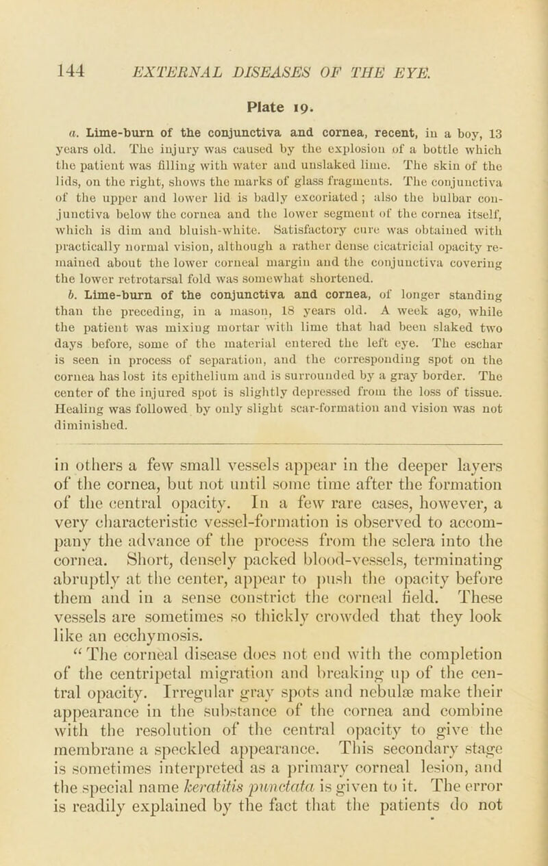 Plate 19. a. Lime-burn of the conjunctiva and cornea, recent, iu a boy, 13 years old. The injury was caused by the explosion of a bottle which the patient was filling with water and unslaked lime. The skin of the lids, on the right, shows the marks of glass fragments. The conjunctiva of the upper and lower lid is badly excoriated; also the bulbar con- junctiva below the cornea and the lower segment of the cornea itself, which is dim and bluish-white. Satisfactory cure was obtained with jiractically normal vision, although a rather dense cicatricial opacity re- mained about the lower corneal margin and the conjunctiva covering the lower retrotarsal fold was somewhat shortened. b. Lime-burn of the conjunctiva and cornea, of longer standing than the preceding, in a mason, 18 years old. A week ago, while the patient was mixing mortar with lime that had been slaked two days before, some of the material entered the left eye. The eschar is seen in process of separation, and the corresponding spot on the cornea has lost its epithelium and is surrounded by a gray border. The center of the injured spot is slightly depressed from the lo.ss of tissue. Healing was followed by only slight scar-formation and vision was not diminished. in others a few small vessels appear in the deeper layers of the cornea, but not until some time after the formation of the central opacity. In a fe^v rare cases, however, a very characteristic ve.ssel-formation is observed to accom- pany the advance of the process from the sclera into the cornea. Short, den.sely packed blood-ve.sscl.s, terminating abruptly at the center, appear to j)ush the opacity before them and in a sense coibstrict the corneal held. These ves.sels are sometimes so thickly crowded that they look like an ecchymosis. “ The corneal disea.se does not end with the completion of the centripetal migration and breaking up of the cen- tral opacity. Irregnlar gray spots and nebulm make their appearance in the substance of the cornea and combine with the resolution of the central opacity to give the membrane a speckled appearance. This secondary stage is sometimes interpreted as a jn’imary corneal lesion, and the special name keratitis p^mdata. is given to it. The error is readily explained by the fact that the patients do not