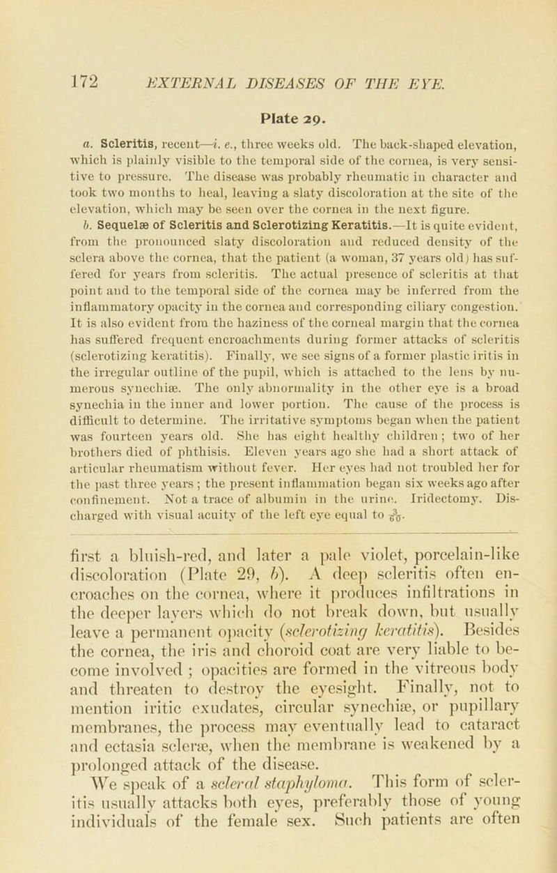 Plate 29. a. Scleritis, recent—i. e., three weeks old. The back-shaped elevation, which is plainly visible to the temporal side of the cornea, is very sensi- tive to pressure. The disease was probably rheumatic in character and look two months to heal, leaving a slaty discoloration at the site of the elevation, which may be seen over the cornea in the next figure. b. Sequelae of Scleritis and Sclerotizing Keratitis.—It is quite evident, from the pronounced slaty discoloration and reduced density of the sclera above the cornea, that the patient (a woman, 37 years old) has suf- fered for j'ears from scleritis. The actual i)reseuce of scleritis at that point and to the temporal side of the cornea may be inferred from the inflammatory opacity in the cornea and corresponding ciliary conge.stion. It is also evident from the haziness of tlie corneal margin that the cornea has sutfered frequent encroachments during former attacks of scleritis (sclerotizing keratitis). Finally, we see signs of a former plastie iritis in the irregular outline of the pui)il, which is attached to the lens by nu- merous synechise. The only abnormality in the other eye is a broad synechia in the inner and lower portion. The cause of the process is difficult to determine. The irritative symi)toms began when the patient was fourteen years old. She has eiglit healthy children; two of her brothers died of phthisis. Eleven years ago she had a short attack of articular rheumatism without fever. Her eyes had not troubled ber for the past three years ; the present inflammation hegan six weeks ago after confinement. Not a trace of albumin in tbe urine. Iridectomy. Dis- charged with visual acuity of the left eye equal to fir.st a bluish-ref], and later a pale Nuolet, porcelain-like di.scoloration (Plate 20, b). A deep scleritis often en- croaches on the cornea, where it produces infiltrations in the deeper lavers which do not break down, but u.sually leave a permanent ojiacity (sclerotizing keratitis). Besides the cornea, the iris and choroid coat are very liable to be- come involved ; opacities are formed in the vitreous body and threaten to de.stroy the eyesight. Finally, not to mention iritic exudates, circular synechiie, or pupillary membranes, the process may eventually lead to cataract and ectasia sclcne, when the membrane is weakened by a ])rolonged attack of the disease. We sjieak of a scleral staphyloma. This form of scler- itis usually attacks both eyes, preferably those of young individuals of the female sex. Such patients are often