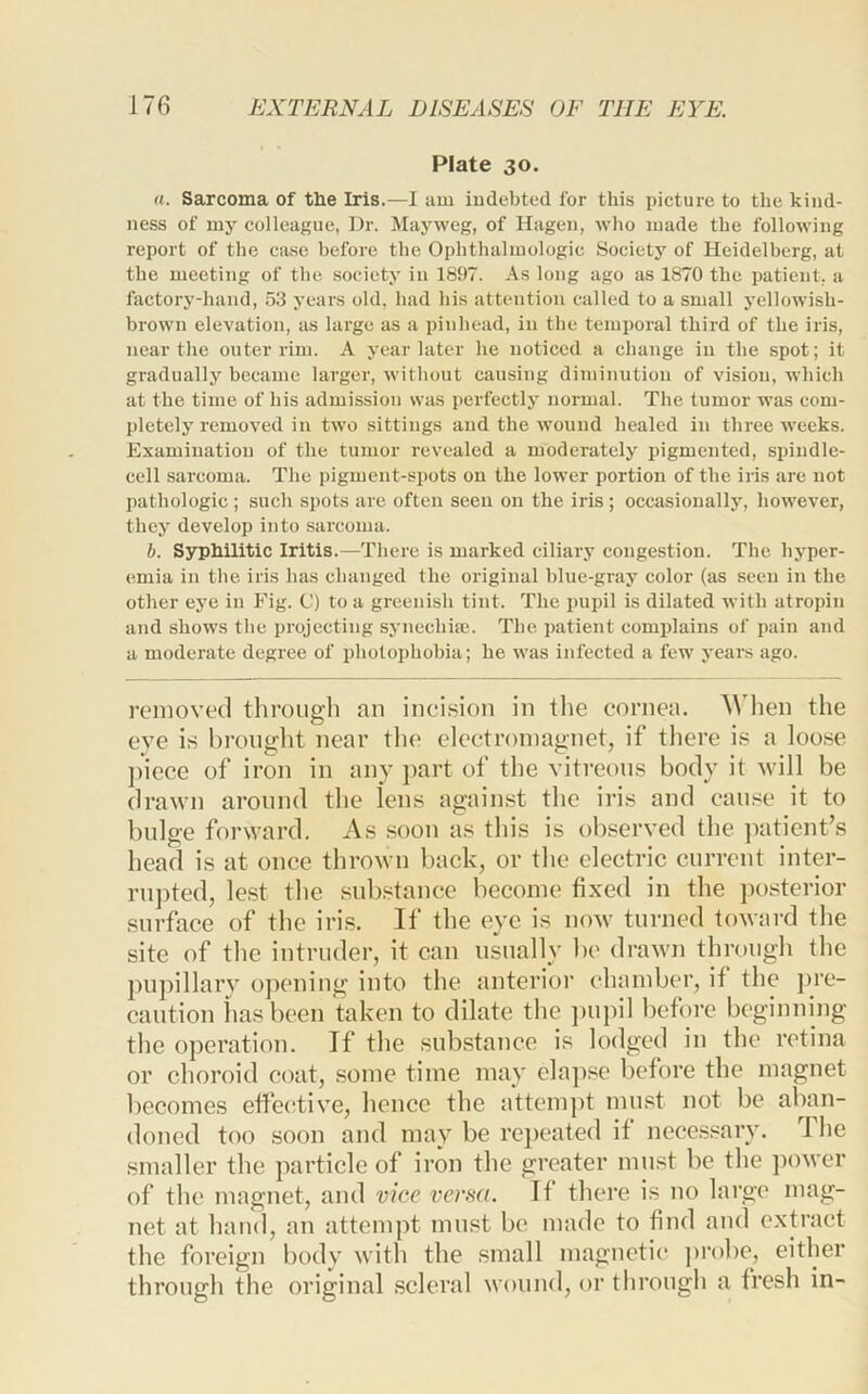 Plate 30, a. Sarcoma of the Iris.—I am indebted for this picture to the kind- ness of my colleague, Dr. Mayweg, of Hagen, who made the following report of the case before the Ophthalmologic Society of Heidelberg, at the meeting of the society in 1897. As long ago as 1870 the patient, a factory-hand, 53 years old, had his attention called to a small yellowish- brown elevation, as large as a pinhead, in the temporal third of the iris, near the outer rim. A year later he noticed a change in the spot; it gradually became larger, without causing diminution of vision, which at the time of his admission was perfectly normal. The tumor was com- pletely removed in two sittings and the wound healed in three W’eeks. Examination of the tumor revealed a moderately pigmented, spindle- cell sarcoma. The pigment-spots on the lower portion of the iris are not pathologic ; such spots are often seen on the iris; occasionally, however, they develop into sarcoma. h. Syphilitic Iritis.—There is marked ciliary congestion. The hyper- emia in the iris has changed the original blue-gray color (as seen in the other eye in Fig. (J) to a greenish tint. The pupil is dilated with atropin and shows the projecting synechiaj. The patient complains of pain and a moderate degree of photophobia; he was infected a few years ago. removed through an ineision in tlie cornea. AVhen the eye is brought near the electromagnet, if tliere is a loose ])iece of iron in any part of the vitreous body it will be drawn around the lens against the iris and cause it to bulge forward. As soon as this is observed the patient’s head is at once thrown back, or the electric current inter- rupted, lest the substance become fixed in the posterior surface of the iris. If the eye is now turned toward the site of the intruder, it can usually be drawn through the pupillary ojiening into the anterior chamber, if the ])re- caution has been taken to dilate the ])upil before beginning the operation. If the substance is lodged in the retina or choroid coat, some time may elapse before the magnet becomes effective, hence the attempt mu.st not be aban- doned too soon and may be re^ieated if necessary. The smaller the particle of iron the greater must be the power of the magnet, and vice versa. If there is no large mag- net at hand, an attempt must be made to find and extract the foreign body with the small magnetic probe, either through the original scleral wound, or through a fresh in-