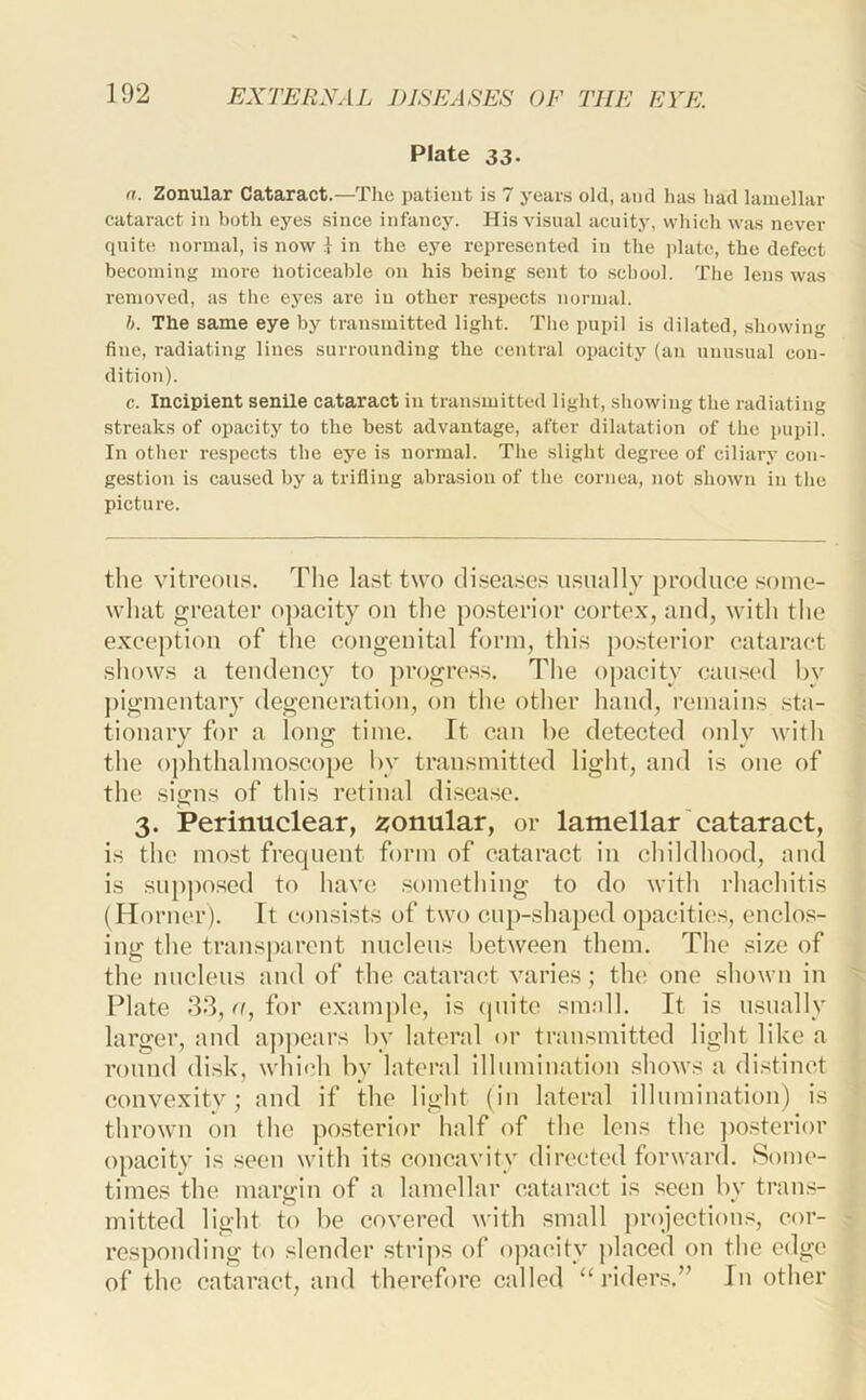 Plate 33. n. Zonular Cataract.—The patient is 7 years old, and has had lamellar cataract in both eyes since infancy. His visual acuity, which was never quite normal, is now i in the eye represented in the plate, the defect becoming more lioticeable on his being sent to scliool. The lens was removed, as the eyes are in other respects normal. ft. The same eye by transmitted light. The pupil is dilated, showing fine, radiating lines surrounding the central opacity (an unusual con- dition). c. Incipient senile cataract in transmitted light, showing the radiating .streaks of opacity to the best advantage, after dilatation of the pupil. In other respects the eye is normal. The slight degree of ciliary con- gestion is caused by a trifling abrasion of the cornea, not shown in the picture. the vitreou.s. The la.st two tliseascis u.sually produce .'Some- what greater ojiataty on the po.sterior cortex, and, witli the exception of the congenital form, thi.s po.sterior cataract .sliows a tendency to jirogrc.s.s. The opacity caused l)v pigmentary degeneration, on the other hand, remain.s .sta- tionary for a lonp; time. It can be detected oidv with the ophthalmo.scope by transmitted light, and is one of the signs of this retinal disease. 3. Perinuclear, ^jonular, or lamellar cataract, is the most frequent form of eataract in childhood, and is snp])oscd to have something to do with rhachitis (Horner). It consists of two enp-shaped opacities, enclos- ing the transparent nnclens between them. The size of the nnclens and of the cataracT varies; the one shown in Plate 33, o, for example, is (piite smell. It is nsnally larger, and ajipears by lateral or transmitted light like a round disk, which by lateral ilhnnination shows a distinct convexity; and if the light (in lateral illumination) is thrown on the po.sterior half of the lens the ])o.sterior opacity is seen with its concavity directed forward. Some- times the margin of a lamellar cataract is seen by trans- mitted light to be covered with small projections, cor- responding to slender .strips of opacity ])laced on the edge of the cataract, and therefore called “ riders.’’ In other