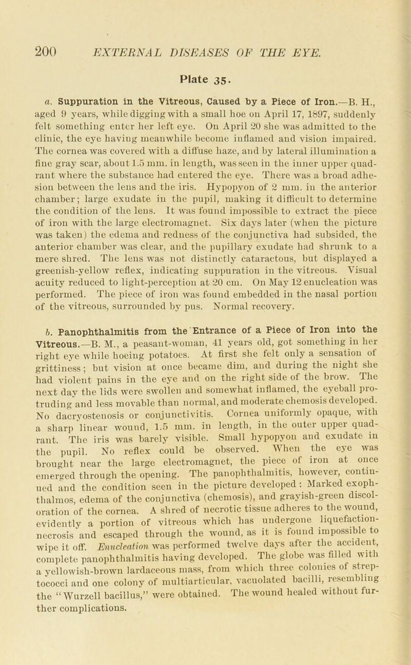 Plate 35. a. Suppuration in the Vitreous, Caused by a Piece of Iron.—B. H., aged 9 years, while digging with a small hoe on April 17, 1897, suddenly felt something enter her left eye. On April 20 she was admitted to the clinic, the eye having meanwhile become inflamed and vision impaired. The cornea was covered with a difl’use haze, and by lateral illumination a fine gray scar, about 1..1 mm. in length, was seen in the inner upper quad- rant where the substance had entered the eye. There was a broad adhe- sion between the lens and the iris. Hypoi)yon of 2 mm. in the anterior chamber; large exudate in the pupil, making it diflicult to determine the condition of the lens. It was found impossible to extract the piece of iron with the large electromagnet. Six days later (when the picture was taken) the edema and redness of the conjunctiva had subsided, the anterior chamber was clear, and the pupillary exudate had shrunk to a mere shred. The lens was not distinctly cataractous, but displayed a greenish-yellow reflex, indicating suppuration in the vitreous. Visual acuity reduced to light-perception at 20 cm. On May 12 enucleation was performed. The piece of iron was found embedded in the nasal portion of the vitreous, surrounded by pus. Normal recovery. h. Panophthalmitis from the Entrance of a Piece of Iron into the Vitreous.—B. M., a peasant-woman, 41 years old, got something in her right eye while hoeing potatoes. At first she felt only a sensation of grittiness; but vision at once became dim, and during the night she had violent pains in the eye and on the right side of the brow. The next dav the lids were swollen and somewhat inflamed, the eyeball pio- truding and less movable than normal, and moderate chemosis developed. No dacryostenosis or conjunctivitis. Cornea uniformly opaque, r\ith a sharp linear rvound, L.'S mm. in length, in the outer upper quad- rant. The iris was barely visible. Small hypopyon and exudate in the pupil. No reflex could be observed. When the eye was brought near the large electromagnet, the piece of iron at once emerged through the opening. The panophthalmitis, however, contin- ned and the condition seen in the picture developed; Marked exoph- thalmos, edema of the conjunctiva (chemosis), and grayish-green discol- oration of the cornea. A shred of necrotic tissue adheres to the wound, evidently a portion of vitreous which has undergone liquefaction- necrosis and escaped through the wound, as it is found impossible to wipe it off. Enucleation was performed twelve days after the accident, complete panophthalmitis having developed. The globe was filled with a yellowish-brown lardaceous mass, from whicb three colonies of strep- tococci and one colony of multiarticular, vacuolated bacilli, resembling the “ Wurzell bacillus,” were obtained. The wound healed without fur- ther complications.