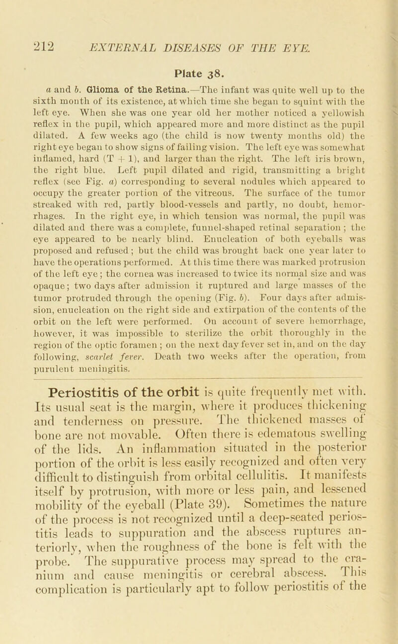 Plate 38. a and h. Glioma of the Retina.—The infant was quite well up to the sixth month of its existence, at which time she began to squint with the left eye. When she was one year old her mother noticed a yellowish reflex in the pupil, which appeared more and more distinct as the pupil dilated. A few weeks ago (the child is now twenty months old) the right eye began to show signs of failing vision. The left eye was somewhat inflamed, hard (T f 1), and larger than the right. The left iris brown, the right blue. Left pupil dilated and rigid, transmitting a bright reflex (sec Fig. a) corresponding to several nodules which appeared to occupy the greater portion of the vitreous. The surface of the tumor streaked with red, partly blood-vessels and partly, no doubt, hemor- rhages. In the right eye, in which tension was normal, the pupil was dilated and there was a coinjilete, fuunel-shaped retinal separation ; tlie eye appeared to be nearly blind. Enucleation of botli eyeballs was proposed and refused; but the child was brought back one year later to have the operations performed. At this time there was marked protrusion of the left eye; the cornea was increased to twice its normal size and was opaque; two days after admission it ruptured and large masses of the tumor protruded through the opening (Fig. b). Four days after admis- sion, enucleation on the right side and extirpation of the contents of the orbit on the left were performed. On account of severe hemorrhage, however, it was impossible to sterilize the orbit thoroughly in the region of the optic foramen ; on the next day fever set in, and on the day following, scarlet fever. Death two weeks after the operation, from purulent meningitis. Periostitis of the orbit i.s quite freqnenlly met with. Its usual seat is tlie margin, where it produees thiekeniiig and tenderness on pressure, d'he thickened masses ot bone are not movable. Often there is edematous swelling of the lids. An inflammation situated in the posterior j)ortion of the orbit is less easily recognized and often very difficult to distinguish from orbital cellulitis. It manifests itself by jirotrusion, with more or less pain, and lessened mobility of the eyeball (Plate 39). Sometimes the nature of the process is not recognized until a deep-seated perios- titis leads to snpjmration and the abscess ruptures an- teriorly, when the roughness of the bone is felt with the probe. The su])purative process may spread to the cra- nium and cause meningitis or cerebral abscess. This complication is particularly apt to follow periostitis of the