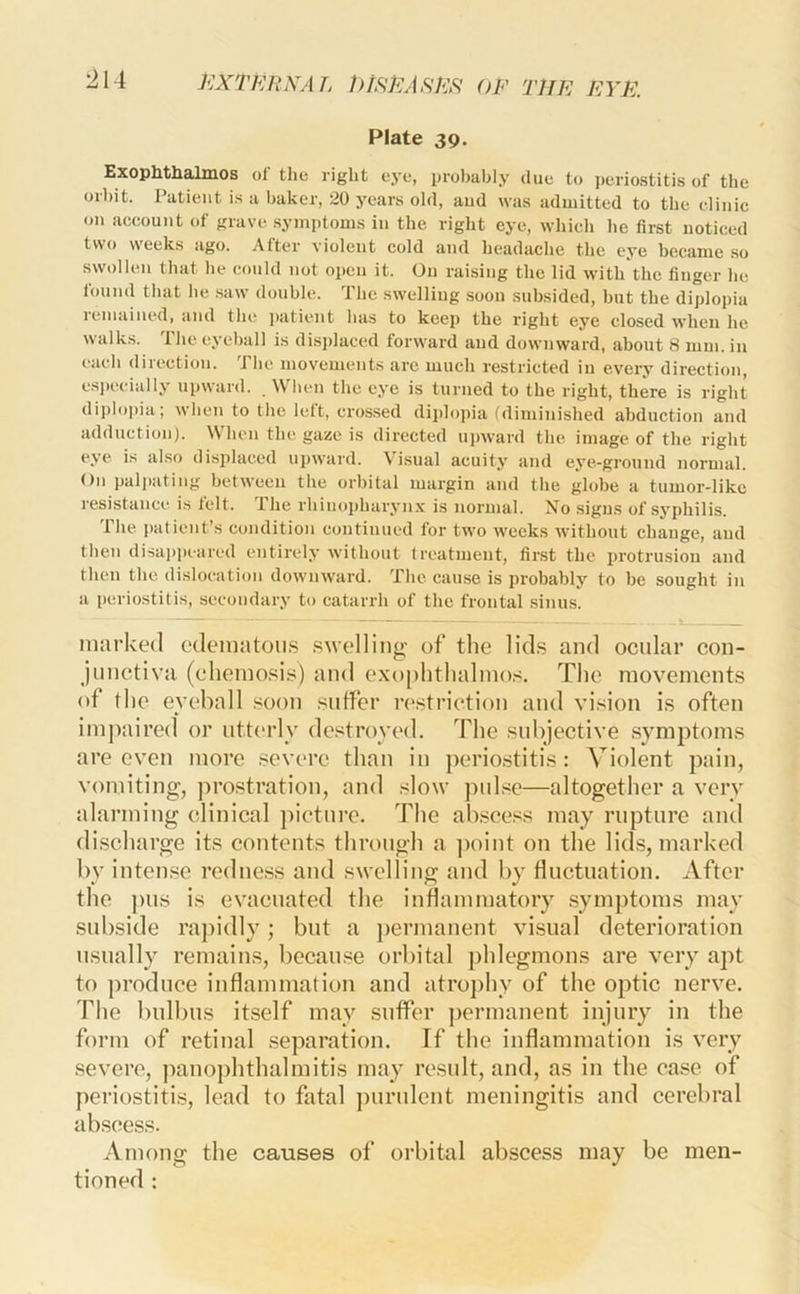 ]<:XTKRNAL t>tRXASl<:S OF THE EYE. Plate 39. Exophthalmos of the right ej-e, probably due to periostitis of the orbit. Patient is a baker, 20 years old, and was admitted to the clinic on account of grave .symptoms in the right eye, which lie first noticed two weeks ago. After violent cold and headaclie the eye became .so swollen that he could not open it. On raising the lid with the finger he found that he .saw double. The swelliug soon subsided, but the diplopia lemained, and the jiatient has to keep the right eye closed when he walks. Ihe eyeball is disiilaced forward and downward, about 8 mm. in each direction. The movements are much restricted in every direction, esjiccially upward. NV hen the eye is turned to the right, there is right diploiiia; when to the left, crossed diplopia (diminished abduction and adduction). When the gaze is directed upward the image of the right eye is also displaced upward. Visual acuity and eye-ground normal. On palpating between the orbital margin and the globe a tumor-like resistance is felt. The rhinopharyn.v is normal. No signs of syphilis. The patient’s condition continued for two weeks without change, and then disaiipeared entirely without treatment, fir.st the protrusion and then the dislocation downward. The cause is probably to be sought in a periostitis, secondary to catarrh of the frontal sinus. marked edemtitoiis swelling of the lids and ocular con- jnnctivti (eheinosis) and exophthalino.'S. The movements of the eyeball .soon suffer restriction and vision is often im]kiired or utterly de.‘^troyed. The subjective symptoms are even more .severe than in perio.stitis: Violent pain, vomiting, jfrostration, and slow pnl.se—altogether a very alarming clinical picture. The ab.scess may rupture and discharge its contents through a ])oint on the lids, marked by inten.se redness and swelling and by fluctuation. After the ])us is evacuated the inflammatory .symptoms may subside rajiidly; but a j)ermanent visual deterioration usually remains, becau.se orlfital phlegmons are very apt to produce inflammation and atrophy of the optic nerve. The bulbus itself may suffer permanent injury in the form of retinal .separation. If the inflammation is very .severe, panophthalmitis may result, and, as in the case of periostitis, lead to fatal ])urnlent meningitis and cerebral abscess. Among the causes of orbital abscess may be men- tioned :