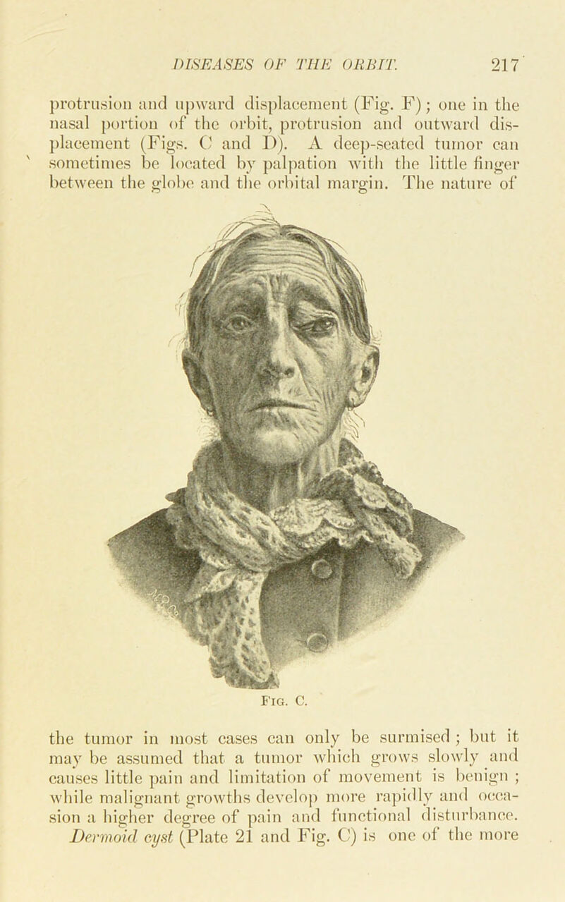 protrii.sioii and uj)ward displacement (Fig. F); one in the nasal portion of the orbit, protrusion and outward dis- })lacement (Figs. C and D), A deep-seated tumor can sometimes be located by palpation Avith the little finger between the globe and the orbital margin. The nature ol‘ Fig. C. the tumor in most cases can only be surmised ; but it may be assumed that a tumor Avhich grows slowly and causes little pain and limitation of movement is benign ; while malignant growths develoj) more rapidly and occa- sion a higher degree of pain and functional disturbance. Dermoid cyst (Plate 21 and Fig. C) is one of the more