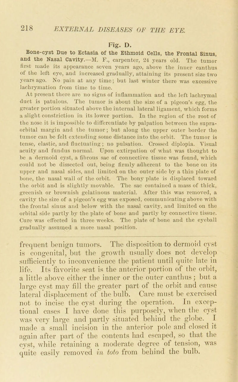 Fig. D. Bone-cyst Due to Ectasia of the Ethmoid Cells, the Frontal Sinus, and the Nasal Cavity.—M. F., carpenter, 24 years old. The tumor first made its appearance seven years ago, above the inner canthus of tlie left eye, and increased gradually, attaining its present size two years ago. No pain at any time; but last winter there was excessive lachryniation from time to time. At present there arc no signs of inflammation and the left lachrymal duct is patulous. The tumor is about the size of a pigeon’s egg, the greater portion situated above the internal lateral ligament, which forms a slight constriction in its lower portion. In the region of the root of the nose it is impossible to differentiate by palpation between the supra- orbital margin and the tumor; but along the u])per outer border the tumor can be felt extending some distance into the orbit. The tumor is tense, elastic, and fluctuating; no pulsation. Crossed diplopia. Visual acuity and fundus normal. Upon extirpation of what was thought to he a dermoid cyst, a fibrous sac of connective tissue was found, which could not be dissected out, being firmly adherent to the bone on its ui)i)er and nasal sides, and limited on the outer side by a thin i)late of hone, the nasal wall of the orbit. The bony plate is displaced toward the orbit and is slightly movable. The .sac contained a mass of thick, greenish or brownish gelatinous material. After this was removed, a cavity the size of a ])igeon’s egg was exposed, communicating above with the frontal sinus and below with the nasal cavity, and limited on the orbital side partly by the plate of bone and partly by connective tissue. Cure was effected in three weeks. The plate of bone and the eyeball gradually assumed a more nasal position. fmjuent b(Miign tumors. Tlio di.sjfo.sition to dermoid evst is congenital, but the growth usually does not develop sufficiently to inconvenience the ])atient until quite late in life. Its favorite seat is the anterior ])ortion of the orbit, a little above either the inner or the outer canthus; but a large cyst may fill the greater part of the orbit and cau.se lateral displacement of the bulb. Care must be excrci.sed not to inci.se the cyst during the ojferation. In excep- tional cases J have done this })urposely, when the cyst was very large and jiartly situated behind the globe. I made a small incision in the anterior polo and closed it again after part of the contents had escaped, so that the cyst, while retaining a moderate degree of tension, was quite easily removed in toto from behind the bulb.