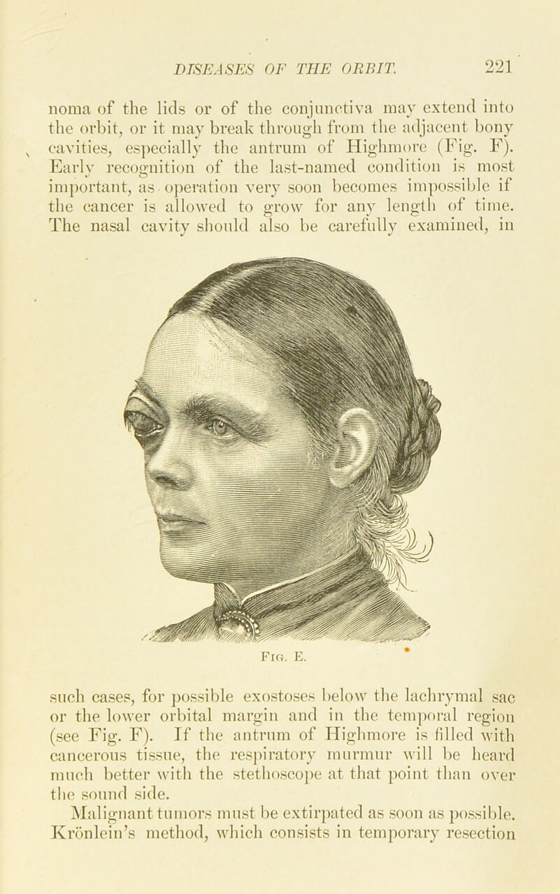 noma of the lids or of the conjunctiva may extend into the orbit, or it may break through from the adjacent bony cavities, especially the antrum of Highmore (Fig. F). Early recognition of the last-named condition is most important, as operation very soon becomes impossible if the cancer is allowed to o-row for anv length of time. The nasal cavity should also be carefidly examined, in such cases, for possible exostoses below the lachrymal sac or the lower orbital margin and in the tem])oi'al region (see Fig. F). If the antrum of Highmore is tilled ivith cancerous tissue, the respiratory murmur will be heard much better with the stethoscojie at that point than over the sound side. Malignant tumors must be extirpated as soon as possible. Kronlein’s method, which consists in temporary resection