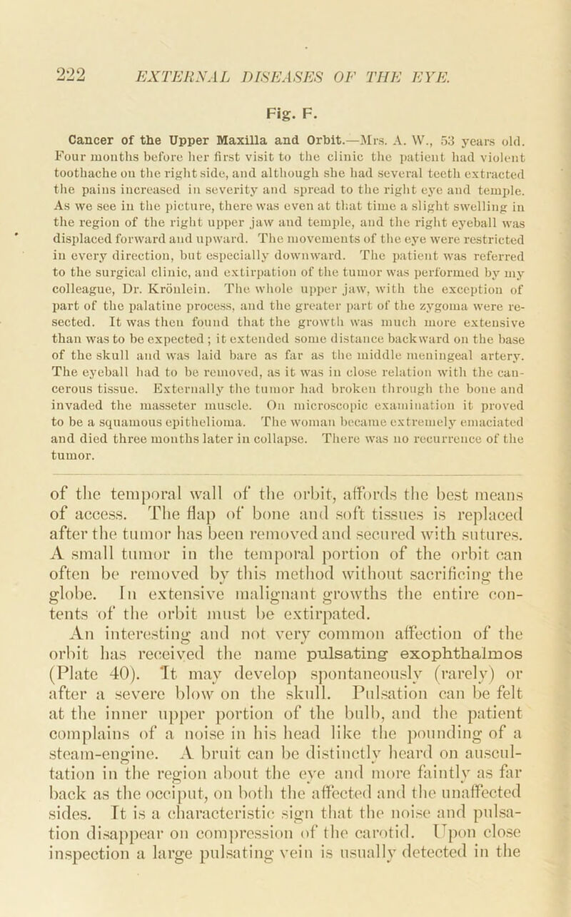 ‘2-29. Fig. F. Cancer of tbe Upper Maxilla and OrPit.—Mrs. A. W., 53 years old. Four mouths before lier first visit to tlie clinic the patient had violent toothache on the right side, and although she had several teeth extracted the pains increased in seveidty and spread to the right ej’e and temi)le. As we see in the picture, there was even at that time a slight swelling in the region of the right upper jaw and temple, and the right eyeball w;is displaced forward and upward. The movements of the eye were restricted in every direction, but especially downward. The patient was referred to the surgical clinic, and e.xtirpation of the tumor was performed by my colleague. Dr. Kroulein. The whole upper jaw, with the exception of part of the palatine process, and the greater part of the zygoma were re- sected. It was then found that the growth was much more extensive than was to be expected ; it extended some distance backward on the base of the skull and was laid bare as far as the middle meningeal artery. The eyeball bad to be removed, as it was in close relation with the can- cerous tissue. Externally the tumor had broken through the bone and invaded the masseter muscle. On microscopic examination it proved to be a squamous epitbelioma. The woman became extremely emaciated and died three months later in collapse. There was no I’ecurrence of the tumor. of the temporal wall of the orbit, affords the best means of access. The flap of bone and soft tissues is replaced after the tumor has been removed and secured with sutures. A small tumor in the temporal portion of the orbit can often be removed by this method without sacrificing the globe. In extensive malignant growths the entire con- tents of the orbit must bo extirpated. An interestini^ and not very common affection of the orbit has received the name pulsating- exophthalmos (Plate 40). ft may develop .spontaneously (rarely) or after a severe blow on the skull. Pulsation can be felt at the inner u])per portion of the bulb, and the patient complains of a noise in his head like the ])ounding of a steam-engine. A bruit can be di.stinctlv heard on au.scul- tation in the region about the eye and more faintly as far back as the occij>ut, on both the affected and the unaffected sides. Ft is a characteri.stic sign that the noise and pidsa- tion di.sappear on com])ression of the carotid. F^pon close inspection a large pulsating vein is usually detected in the