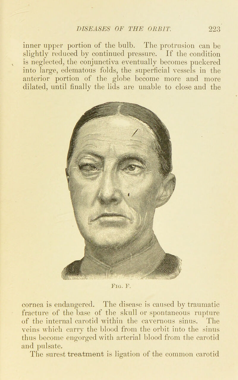 inner upper portion of the bulb. The protrusion can be slightly reduced by continued pressure. If the condition is neglected, the conjunctiva eventually becomes puckered into large, edematous folds, the superficial vessels in the anterior portion of the globe become more and more dilated, until finally the lids are unable to close and the Fig. F. cornea is endangered. The disease is cau.sed by traumatic fracture of the base of the skull or spontaneous rupture of the internal carotid Avithin the cavernous sinus. The veins which carry the blood from the orliit into the sinus thus become engorged with arterial blood from the carotid and pulsate. The surest treatment is ligation of the common carotid