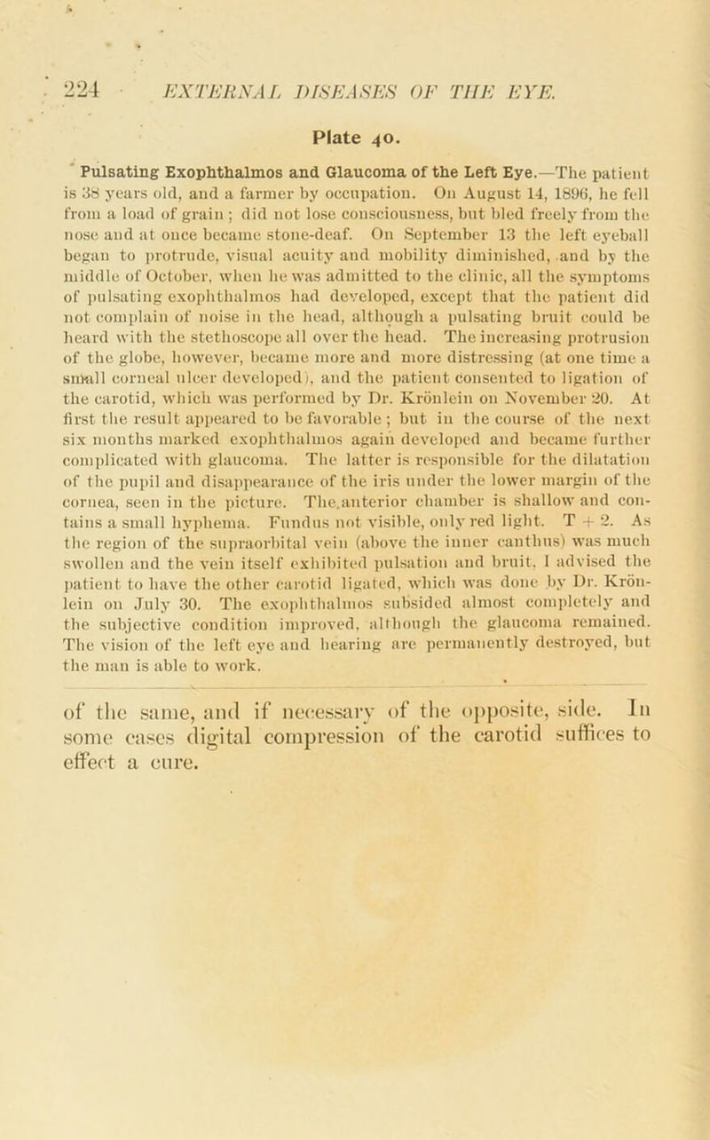 Plate 40. ‘ Pulsating Exophthalmos and Glaucoma of the Left Eye.—The patient is 38 years old, and a farmer by occupation. On August 14, 1896, he fell from a load of grain ; did not lose consciousness, but bled freely from the nose and at once became stone-deaf. On September 13 the left eyeball began to protrude, visual acuity and mobility diminished, and by the middle of October, when be was admitted to the clinic, all the symptoms of pulsating exophthalmos liad developed, except that the patient did not complain of noise in the head, although a pulsating bruit could be heard with the stethoscope all over the head. The increasing protrusion of the globe, however, became more and more distressing (at one time a siuftll corneal ulcer developed), and the patient consented to ligation of the carotid, which was performed bj’^ Dr. Kroulein on November 20. At first the result appeared to be favorable ; but in the course of the next six months marked exophthalmos again developed and became further complicated with glaucoma. The latter is responsible for the dilatation of the pupil and disappearance of the iris under the lower margin of the cornea, seen in the picture. The.anterior chamber is shallow and con- tains a small hyphema. Fundus not visible, only red light. T + 2. As the regioji of the supraorbital vein (above the inner canthus) was much swollen and the vein itself exhibited pulsation and bruit. 1 advised the jiatient to have the other carotid ligated, which was done by Dr. Kion- lein on July 30. The exophthalmos .subsided almost completely' and the subjective condition improved, althougli the. glaucoma remained. The vision of the left ey'e and hearing are permanently destroyed, but the man is able to work. of the same, and if necessary of the o])po.site, side. In some cases digital compression of the carotid suffices to effect a cure.