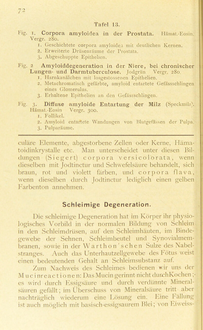 Tafel 18. Fig. i. Corpora amyloidea in der Prostata. Hämat.-Eosin. Vergr. 2S0. 1. Geschichtete corpora amyloidea mit deutlichen Kernen. 2. Erweiterte Drüsenräume der Prostata. 3. Abgeschuppte Epithelien. Fig. 2 Amyloiddegeneration in der Niere, bei chronischer Lungen- und Darmtuberculose. Jodgrün Vergr. 2S0. 1. Harnkanälchen mit losgestossenen Epithelien. 2. Metachromatisch gefärbte, amyloid entartete Gefässschlingen eines Glomerulus. 3. Erhaltene Epithelien an den Gefässschlingen. Fig. 3. Diffuse amyloide Entartung der Milz (Speckmilz). Hämat.-Eosin Vergr. 300. 1. Follikel. 2. Amyloid entartete Wandungen von Blutgefässen der Pulpa. 3. Pulparäume. cttläre Elemente, abgestorbene Zellen oder Kerne, Häma- toidinkrystalle etc. Man unterscheidet unter diesen Bil- dungen (Siegert) corpora versicolorata, wenn dieselben mit Jodtinctur und Schwefelsäure behandelt, sich braun, rot und violett färben, und corpora flava, wenn dieselben durch Jodtinctur lediglich einen gelben Farbenton annehmen. Schleimige Degeneration. Die schleimige Degeneration hat im Körper ihr physio- logisches Vorbild in der normalen Bildung von Schleim in den Schleimdrüsen, auf den Schleimhäuten, im Binde- gewebe der Sehnen, Schleimbeutel und Synovialmem- branen, sowie in der Warthon’ s c h e n Sülze des Nabel- stranges. Auch das Unterhautzellgewebe des Fötus weist einen bedeutenden Gehalt an Schleimsubstanz auf. Zum Nachweis des Schleimes bedienen wir uns der Muci nreac t i o ne n: DasMucin gerinnt nicht durchKochen ;• es wird durch Essigsäure und durch verdünnte Mineral- säuren gefällt; im Überschuss von Mineralsäure tritt aber nachträglich wiederum eine Lösung ein. Eine Fällung ist auch möglich mit basisch-essigsaurem Blei; von Eiweiss-