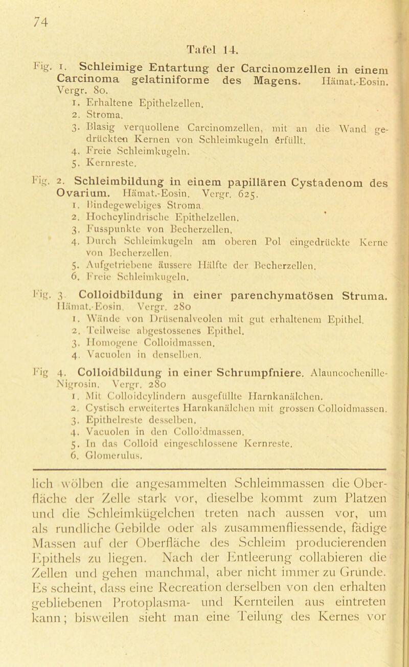 Tafel 14. Fig. i. Schleimige Entartung der Carcinomzellen in einem Carcinoma gelatiniforme des Magens. Hämat.-Eosin. Vergr. So. 1. Erhaltene Epithelzellen. 2. Stroma. 3. Blasig verquollene Carcinomzellen, mit an die Wand ge- drückten Kernen von Schleimkugeln Erfüllt. 4. Freie Schleimkugeln. 5. Kernreste. Fig. 2. Schleimbildung in einem papillären Cystadenom des Ovarium. Hämat.-Eosin. Vergr. 625. 1. Bindegewebiges Stroma. 2. Hochcylindrische Epithelzellen. 3. Fusspunkte von Becherzellen. 4. Durch Schleimkugeln am oberen Pol eingedrückte Kerne von Becherzellen. 5. Aufgetriebene äussere Hälfte der Becherzellen. 6. Freie Schleimkugeln. Fig. 3 Colloidbildung in einer parenchymatösen Struma. Hämat.-Eosin. Vergr. 2S0 1. Wände von Drüsenalveolen mit gut erhaltenem Epithel. 2. Teilweise abgestossencs Epithel. 3. Homogene Colloidmassen, 4. Vacuolen in denselben. Fig 4- Colloidbildung in einer Schrumpfniere. Alauncochenille- Nigrosin. Vergr. 280 1. Mit Colloidcylindern ausgeftlllte Harnkanälchen. 2. Cystisch erweitertes Harnkanälchen mit grossen Colloidmassen. 3. Epithelreste desselben. 4. Vacuolen in den Colloidmassen, 5. In das Colloid eingescldossenc Kernreste. 6. Glomerulus. lieh wölben die angesammelten Schleimmassen die Ober- fläche der Zelle stark vor, dieselbe kommt zum Platzen und die Schleimkügelchen treten nach aussen vor, um als rundliche Gebilde oder als zusammenfliessende, fädige Massen auf der Oberfläche des Schleim producierenden Epithels zu liegen. Nach der Entleerung collabieren die Zellen und gehen manchmal, aber nicht immer zu Grunde. Es scheint, dass eine Recreation derselben von den erhalten gebliebenen Protoplasma- und Kernteilen aus eintreten kann; bisweilen sieht man eine Teilung des Kernes vor