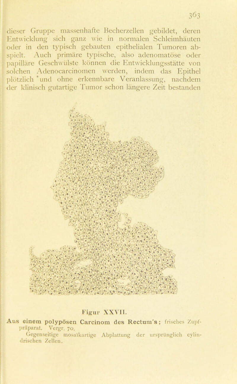 dieser Gruppe massenhafte Becherzellen gebildet, deren Entwicklung sich ganz wie in normalen Schleimhäuten oder in den typisch gebauten epithelialen Tumoren ab- spielt. Auch primäre typische, also adenomatöse oder papilläre Geschwülste können die Entwicklungsstätte von solchen Adenocarcinomen werden, indem das Epithel plötzlich ‘und ohne erkennbare Veranlassung, nachdem der klinisch gutartige Tumor schon längere Zeit bestanden Aus einem polypösen Carcinom des Rectum’s; frisches Zupf- präparat. Vergr. 70. Gegenseitige mosaikartige Abplattung der ursprünglich cylin- drischen Zellen.