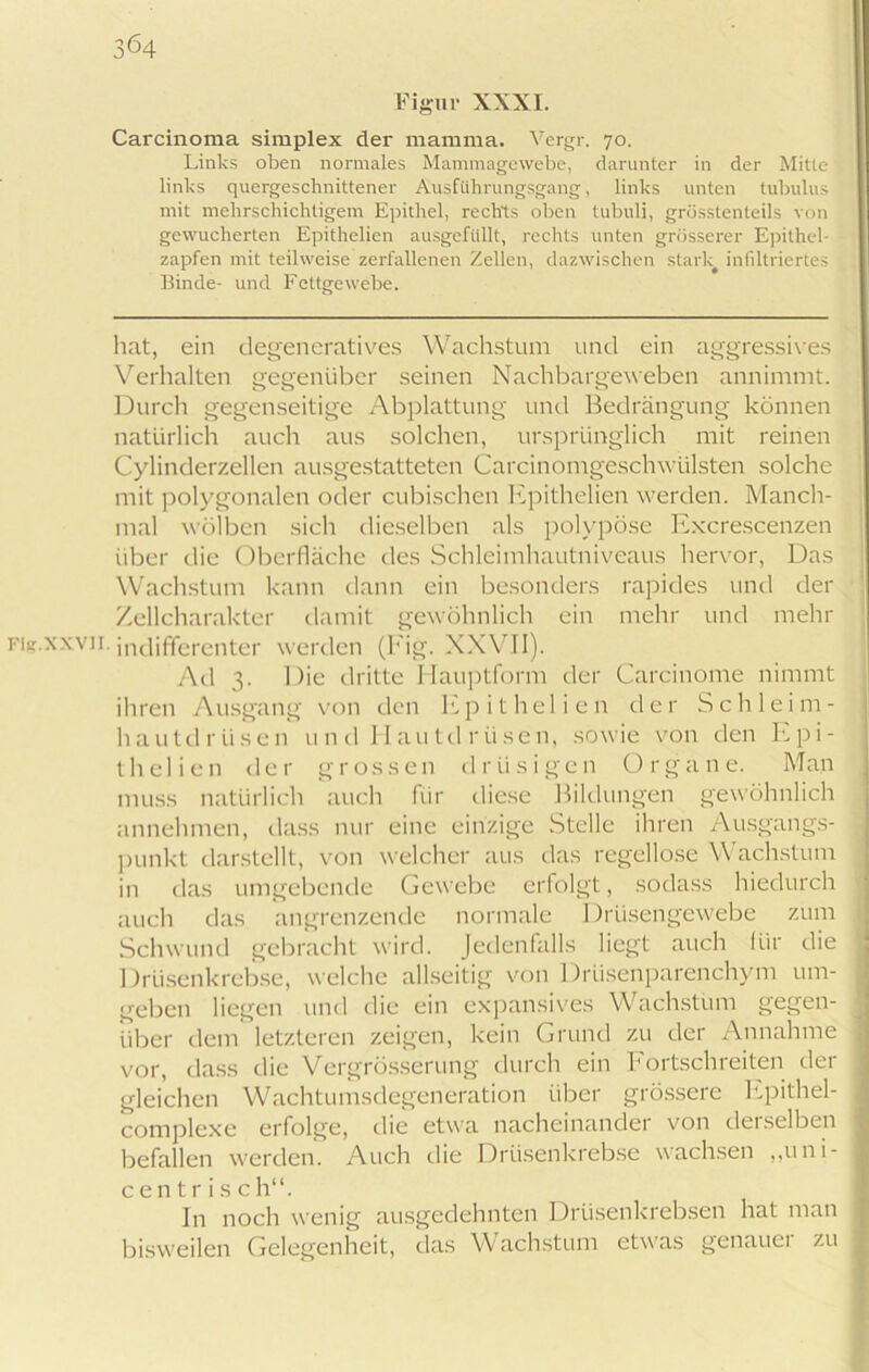 Figur XXXI. Carcinoma simplex der mamma. Vergr. 70. Links oben normales Mammagewebe, darunter in der Mitte links quergeschnittener Ausführungsgang, links unten tubulus mit mehrschichtigem Epithel, rechts oben tubuli, grösstenteils von gewucherten Epithelien ausgefiillt, rechts unten grösserer Epithel- zapfen mit teilweise zerfallenen Zellen, dazwischen stark# infiltriertes Binde- und Fettgewebe. hat, ein degeneratives Wachstum und ein aggressives Verhalten gegenüber seinen Nachbargeweben annimmt. Durch gegenseitige Abplattung und Bedrängung können natürlich auch aus solchen, ursprünglich mit reinen Cylinderzellen ausgestatteten Carcinomgeschwülsten solche mit polygonalen oder cubischen Epithelien werden. Manch- mal wölben sich dieselben als polypöse Excrescenzen über die Oberfläche des Schleimhautniveaus hervor, Das Wachstum kann dann ein besonders rapides und der Zellcharakter damit gewöhnlich ein mehr und mehr icr.xxvn. indifferenter werden (Fig. XXVII). Ad 3. Die dritte Hauptform der Carcinome nimmt ihren Ausgang von den Epithelien der Schleim- hautdrüsen und Hautdrüsen, sowie von den Epi- thelien der grossen drüsigen Organe. Man muss natürlich auch für diese Bildungen gewöhnlich annehmen, dass nur eine einzige Stelle ihren Ausgangs- punkt darstellt, von welcher aus das regellose V achstum in das umgebende Gewebe erfolgt, sodass hiedurch auch das angrenzende normale Drüsengewebe zum Schwund gebracht wird. Jedenfalls liegt auch für die Drüsenkrebse, welche allseitig von Drüsenparenchym um- geben liegen und die ein expansives Wachstum gegen- über dem letzteren zeigen, kein Grund zu der Annahme vor, dass die Vergrösserung durch ein Fortschreiten der gleichen Wachtumsdegeneration über giösseie Epithel- complexe erfolge, die etwa nacheinander von derselben befallen werden. Auch die Drüsenkrebse wachsen „uni- centr is ch“. ln noch wenig ausgedehnten Drüsenkrebsen hat man bisweilen Gelegenheit, das Wachstum etwas genauer zu ;