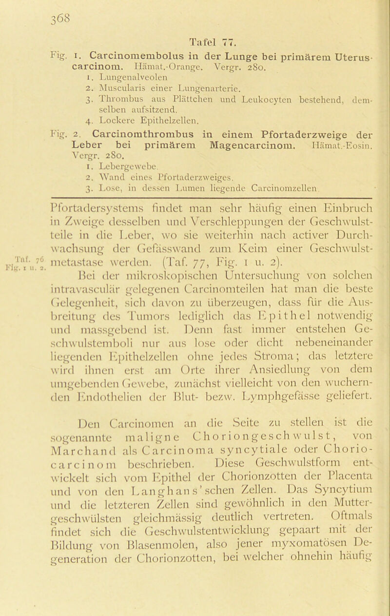 Tafel 77. Fig. i. Carcinomembolus in der Lunge bei primärem Uterus- carcinom. Hämat.-Orange. Vergr. 2S0. 1. Lungenalveolen 2. Muscularis einer Lungenarterie. 3. Thrombus aus Plättchen und Leukocyten bestehend, dem- selben aufsitzend. 4. Lockere Epithelzellen. Fig. 2. Carcinomthrombus in einem Pfortaderzweige der Leber bei primärem Magencarcinom. Hämat.-Eosin. Vergr. 2 So. 1. Lebergewebe 2. Wand eines Pfortaderzweiges. 3. Lose, in dessen Lumen liegende Carcinomzellen Pfortadersystems findet man sehr häufig einen Einbruch in Zweige desselben und Verschleppungen der Geschwulst- teile in die Leber, wo sie weiterhin nach activer Durch- wachsung der Gefässwand zum Keim einer Geschwulst- u7“ metastase werden. (Taf. 77, Fig. 1 u. 2). Hei der mikroskopischen Untersuchung von solchen intravasculär gelegenen Carcinomteilen hat man die beste Gelegenheit, sich davon zu überzeugen, dass für die Aus- breitung des Tumors lediglich das Epithel notwendig und massgebend ist. Denn fast immer entstehen Ge- schwulstemboli nur aus lose oder dicht nebeneinander liegenden Epithelzellen ohne jedes Stroma; das letztere wird ihnen erst am Orte ihrer Ansiedlung von dem umgebenden Gewebe, zunächst vielleicht von den wuchern- den Endothelien der Blut- bezw. Lymphgefässe geliefert. Den Carcinomen an die Seite zu stellen ist die sogenannte maligne Choriongeschwulst, von Marchand als Carcinoma syncytiale oder Chorio- carcinom beschrieben. Diese Geschwulstform ent- wickelt sich vom Epithel der Chorionzotten der Placenta und von den Lang hau s’ sehen Zellen. Das Syncytium und die letzteren Zellen sind gewöhnlich in den Mutter- geschwülsten gleichmässig deutlich vertreten. Oftmals findet sich die Geschwulstentwicklung gepaart mit dei Bildung von Blasenmolen, also jener myxomatösen De- generation der Chorionzotten, bei welcher ohnehin häufig