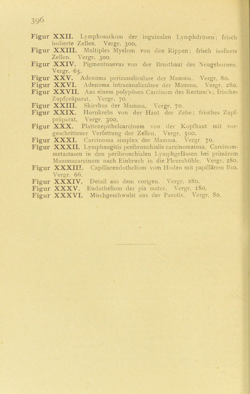 596 Figur Figur Figur Figur Figur Figur Figur Figur Figur Figur Figur Figur Figur Figur Figur inguinalen Lymphdrüsen; frisch von den Rippen; frisch isolierte XXII. Lymphosarkom der isolierte Zellen. Vergr. 300. XXIII. Multiples Myelom Zellen. Vergr. 300. XXIV. Pigmentnaevus von der Brusthaut des Xeugebornen. Vergr. 65. XXV. Adenoma pericanaliculare der Mamma. Vergr. So. XXVI. Adenoma intracanaliculare der Mamma. Vergr. 2S0. XXVII. Aus einem polypösen Carcinom des Rectum’s; frisches Zupfpräparat. Vergr. 70. XXIII. Slcirrhus der Mamma. Vergr. 70. XXIX. Hornkrebs von der Plaut der Zehe; frisches Zupf- präparat. Vergr. 300. XXX. Plattenepithelcarcinom von der Kopfhaut mit vor- geschrittener Verfettung der Zellen. Vergr. 500. XXXI. Carcinoma simplex der Mamma. Vergr 70. XXXII. Lymphangitis peribroncliialis carcinomatosa. Carcinom- metastasen in den peribronchialen Lymphgefässen bei primärem Mammacarcinom nach Einbruch in die Pleurahöhle. Vergr. 2S0. XXXIII. Vergr. 66. XXXIV. XXXV. XXXVI. Capillarendotheliom vom Hoden mit papillärem Bau. Detail aus dem vorigen. Vergr. 2S0. Endotheliom der pia mater. Vergr. 1S0. Mischgeschwulst aus der Parotis, Vergr. So.