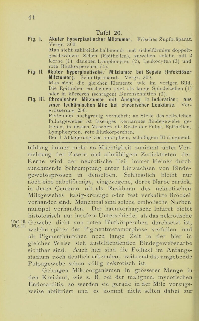 1 Tafel 20. j Fig. I. Akuter hyperplastischer Milztumor. Frisches Zupfpräparat. Vergr. 300. Man sieht zahlreiche halbmond- und sichelförmige doppelt- geschwänzte Zellen fEpithelienj, zuweilen solche mit 2 Kerne (1), daneben Lymphocyten (2), Leukocyten (3) und rote Blutkörperchen (4). Fig. II. Akuter hyperplastische, Milzlumor bei Sepsis (Infektiöser Milztumor). Schnittpräparat. Vergr. 300. ' Man sieht die gleichen Elemente wie im vorigen Hild. Die Epithelien erscheinen jetzt als lange Spindelzellen (1) oder in kürzeren (schrägen) Durchschnitten (2). Fig. III. Chronischer Milztumor mit Ausgang in Induration; aus i einer leukämischen Milz bei chronischer Leukämie. Ver- grösserung 250. Reticulum hochgradig vermehrt; an Stelle des zellreichen Pulpagewebes ist faseriges kernarmes Bindegewebe ge- ] treten, in dessen Maschen die Reste der Pulpa, Epithelien, ■> Lymphocyten. rote Blutkörperchen. Bei 1 Ablagerung von amorphem, scholligem Blutpigment. bildung; immer mehr an Mächtio'keit zunimmt unter Ver- mehrung der Irasern und allmähligem Zurücktreten der Kerne wird der nekrotische Teil immer kleiner durch zunehmende Schrumpfung unter Einwachsen von Binde- gewebssprossen in denselben. Schliesslich bleibt nur noch eine nabelförmige, eingezogene, derbe Narbe zurück, in deren Centrum oft als Residuum des nekrotischen Milzgewebes käsig-kreidige oder fest verkalkte Brockel vorhanden sind. Manchmal sind solche embolische Narben • multipel vorhanden. Der haemorrhagische Infarct bietet histologrisch nur insofern Unterschiede, als das nekrotische I Gewebe tlicht von roten Blutkörperchen durchsetzt ist, welche später der Pigmentmetamorphose verfallen und j als Figmenthäufchen noch lange Zeit in der hier in gleicher Weise sich ausbildendenden Bindegewebsnarbe sichtbar sind. Auch hier sind die Follikel im Anfangs- ^ Stadium noch deutlich erkennbar, während das umgebende ! Pulpagewebe schon völlig nekrotisch ist. Gelangen Mikroorganismen in grösserer Menge in t den Kreislauf, wie z. B. bei der malignen, mycotischen Endocarditis, so werden sie gerade in der Milz vorzugs- weise abfiltriert und es kommt nicht selten dabei zur