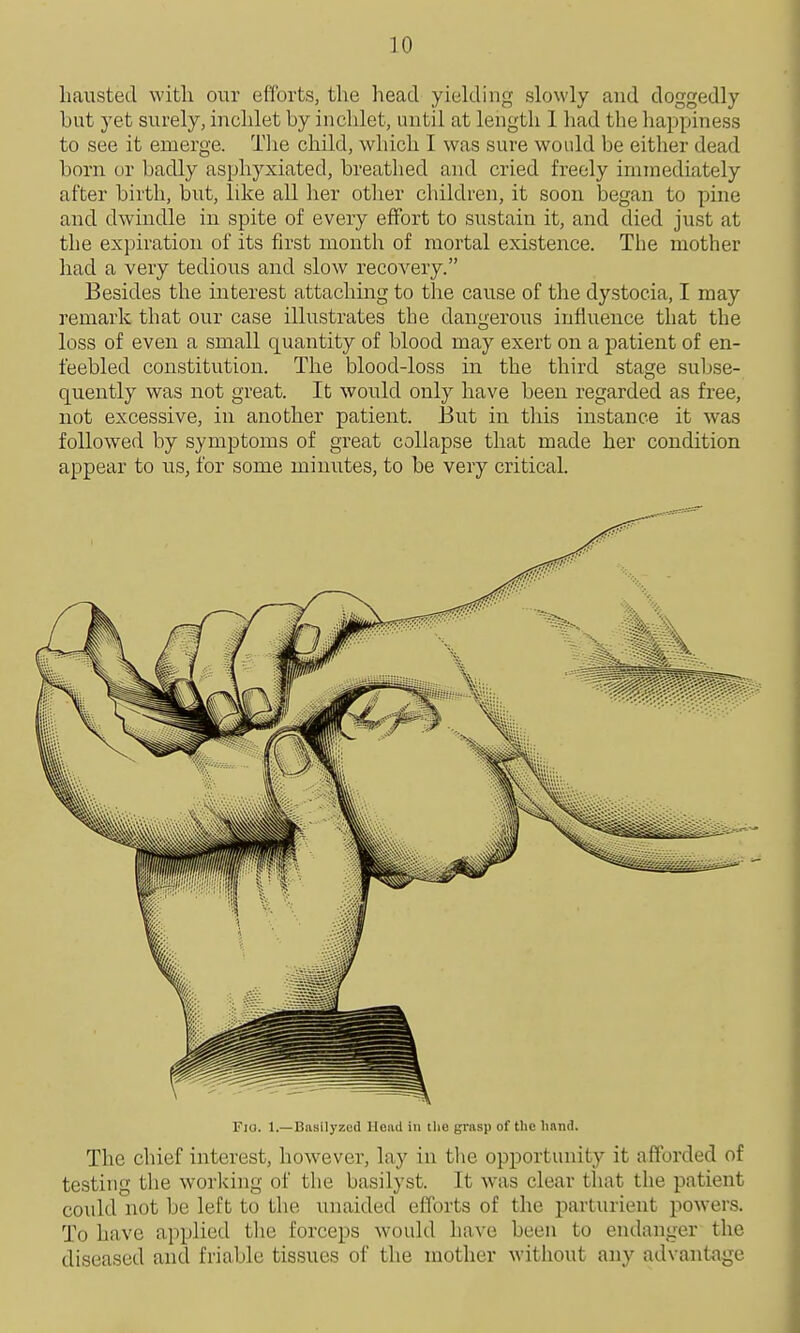 liausted with our efforts, the head yiekling slowly and doggedly but yet surely, hrchlet by inchlet, until at length 1 had the happiness to see it emerge. Tlie child, which I was sure would be either dead born or badly asphyxiated, breathed and cried freely immediately after birth, but, like all her other children, it soon began to pine and dwindle in spite of every effort to sustain it, and died just at the expiration of its first month of mortal existence. The mother had a very tedious and slow recovery. Besides the interest attaching to the cause of the dystocia, I may remark that our case illustrates the dangerous influence that the loss of even a small quantity of blood may exert on a patient of en- feebled constitution. The blood-loss in the third stage subse- quently was not great. It would only have been regarded as free, not excessive, in another patient. But in this instance it was followed by symptoms of great collapse that made her condition appear to us, for some minutes, to be very critical. Fio. 1.—Basilyzed Head in the grasp of the hand. The chief interest, however, lay in tlie opportunity it afforded of testing the working of the basilyst. It was clear that the patient could not be left to the unaided efforts of the parturient powers. To have applied tlie forceps would have been to endanger the diseased and friable tissues of the mother without any advantage