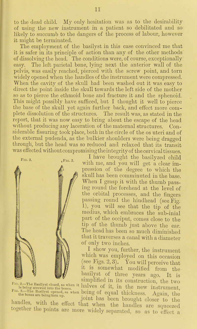 Fig. 2. I Fig. 3. to the dead child. My only hesitation was as to the desirability of using the new instrument in. a patient so debilitated and so likely to succumb to the dangers of the process of labour, however it might be terminated. The employment of the basilyst in this case convinced me that it is safer in its principle of action than any of the other methods of dissolving the head. The conditions were, of course, exceptionally easy. The left parietal bone, lying next the anterior wall of the pelvis, was easily reached, pierced with the screw point, and torn widely opened when the handles of the instrument were compressed. When the cavity of the skull had been washed out it was easy to direct the point uiside the skull towards the left side of the mother so as to pierce the ethmoid bone and fracture it and the sphenoid. Tliis might possibly have sufficed, but I thought it well to pierce the base of the skull yet again furtlier back, and effect more com- plete dissolution of the structures. The result was, as stated in the report, that it was now easy to bring about the escape of the head without producing any laceration of the maternal structures. Con- siderable Assuring took place, both in the circle of the os uteri and of the external pudenda, as the bulkier shoulders were being dragged through, but the head was so reduced and relaxed that its transit was effected without compromising the integrity of the cervical tissues. I have brought the basilyzed child with me, and you will get a clear im- pression of the degree to which the skull has been comminuted in the base. When I grasp it with the tliumb pass- ing round the forehead at the level of the orbital processes, and the fingers passing round the hindhead (see Fig. 1), you will see that the tip of the medius, which embraces the sub-inial part of the occiput, comes close to the tip of tlie thumb just above the ear. The head has been so much diminished tliat it traverses a canal with a diameter of only two inches. I show you, further, the instrument which was employed on this occasion (see Figs. 2,3). You will perceive that it is somewhat modified from the basilyst of three years ago. It is simplified in its construction, the two ' it, in the new instrument, ''^Il^ri!^I,C'il'^''''l^^'g:^f '''^'■'''^ thickness. Again, the 1 „ n joint has been brought closer to the togethei the pomts are more widely separated, so as to efibct a