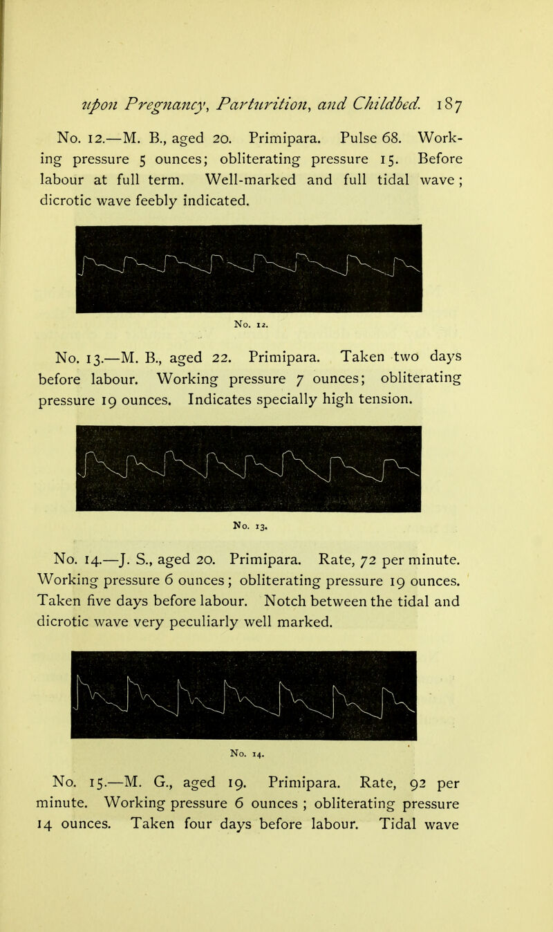 No. 12.—M. B., aged 20. Primipara. Pulse 68. Work- ing pressure 5 ounces; obliterating pressure 15. Before labour at full term. Well-marked and full tidal wave; dicrotic wave feebly indicated. No. 12. No. 13.—M. B., aged 22. Primipara. Taken two days before labour. Working pressure 7 ounces; obliterating pressure 19 ounces. Indicates specially high tension. No. 13. No. 14.—J. S., aged 20. Primipara. Rate, 72 per minute. Working pressure 6 ounces; obliterating pressure 19 ounces. Taken five days before labour. Notch between the tidal and dicrotic wave very peculiarly well marked. No. 14. No. 15.—M. G., aged 19. Primipara. Rate, 92 per minute. Working pressure 6 ounces ; obliterating pressure 14 ounces. Taken four days before labour. Tidal wave