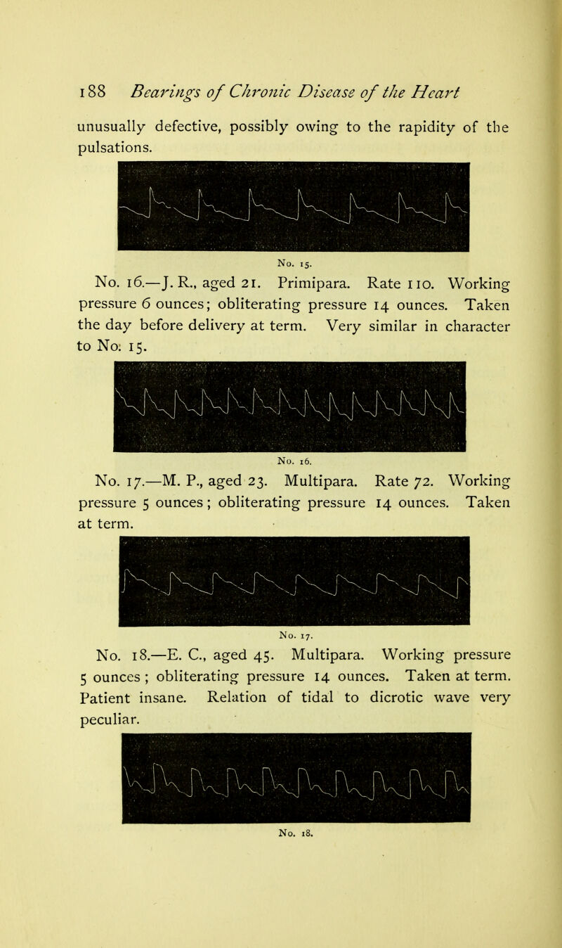 unusually defective, possibly owing to the rapidity of the pulsations. No. 15. No. 16.—J. R., aged 21. Primipara. Rate no. Working pressure 6 ounces; obliterating pressure 14 ounces. Taken the day before delivery at term. Very similar in character to No. 15. \ \ fx -K \\ \ f\ K K v_ \ \ ■ \ \ ^ \ V \ \ \ \ \ \ - XI ^ No. 16. No. 17.—M. P., aged 23. Multipara. Rate 72. Working pressure 5 ounces; obliterating pressure 14 ounces. Taken at term. No. 17. No. 18.—E. C, aged 45. Multipara. Working pressure 5 ounces ; obliterating pressure 14 ounces. Taken at term. Patient insane. Relation of tidal to dicrotic wave very peculiar. \ ■ A h ■ 'A r r