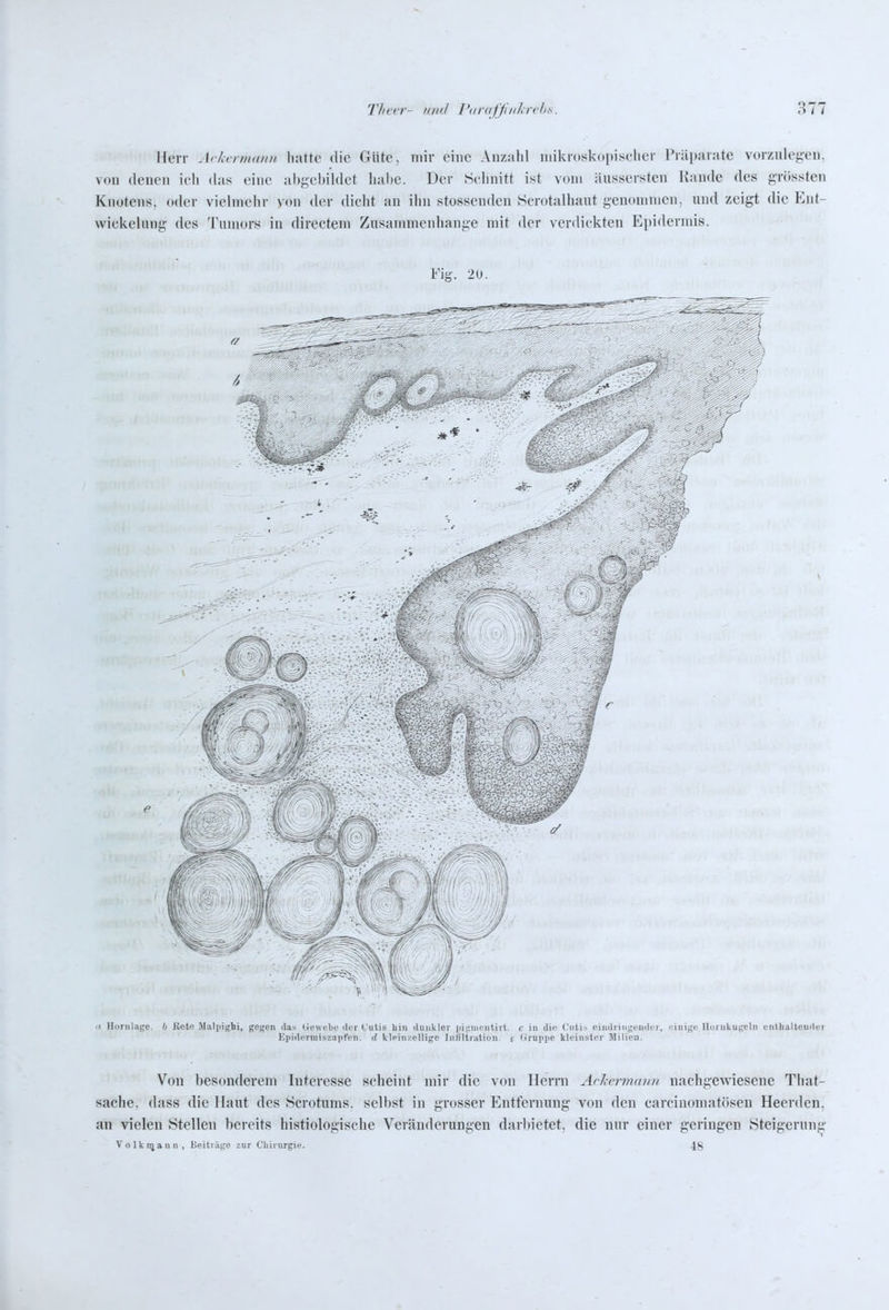 Herr Arhvrmann hatte die Güte, mir eine Anzahl mikroskopischer Präparate vorzuleg-en. von denen ich das eine ahj^childct hal)C. Der Sclmitt ist vom äusserstcn Kande des grössten Knotens, oder vielmclir von der dicht au ihn stossenden Scrotalhaut genommen, und zeigt die Eut- wickelung des Tumors in directem Zusammenhange mit der verdickten Epidermis. Fig. 20. e « Iloinlage. h Kete ilaliiighi, gegen das Uewebe der Cutis hin dunkler iiitiiiioiitirl. c in die Ciili.^ eindringeuder, eiuige Uuniliugeln entlmllender Kpidirmiszaiifen. d kleiii/ellige In/iltnttion. i Grupiie kleinster Milien. Von besonderem Interesse scheint mir die von Herrn ArhvrmaiDi nachgewiesene That- sache, dass die Haut des Scrotums. selbst in grosser Entfernung von den carcinomatöseu Heerdcn, an vielen Stellen bereits histiologische Veränderungen darl)ietet. die nur einer geringen Steigerung Volknjann, Beiträge zur Cliirurgie. 4g