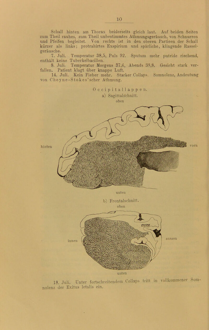 Schall hinten am Thorax beiderseits gleich laut. Auf beiden Seiten zum Theil rauhes, zum Theil unbestimmtes Athmungsgeräusch, von Schnurren und Pfeifen begleitet. Von rechts ist in den oberen Partieen der Schall kürzer als links; protrahirtes Exspiriuin und spärliche, klingende Rassel- geräusche. 7. .luli. Temperatur 38,5, Puls 92. Sputum mehr putride riechend, enthält keine Tuberkelbacillen. 8. Juli. Temperatur Morgens 37,6, Abends 38,8. Gesicht stark ver- fallen. Patient klagt über knappe Luft. 14. Juli. Kein Fieber mehr. Starker Collaps. Somnolenz, Andeutung von Cheyne-Stokes’scher Athmung. 0 c c i p i t a 1 1 a ]) p e n. a) Sagittal^chnitt. oben unten b) Frontalschnitt, oben unten 18. Juli. Unter fortschreitendem Collaps tritt in vollkommenei Som nolenz der Exitus letalis ein.