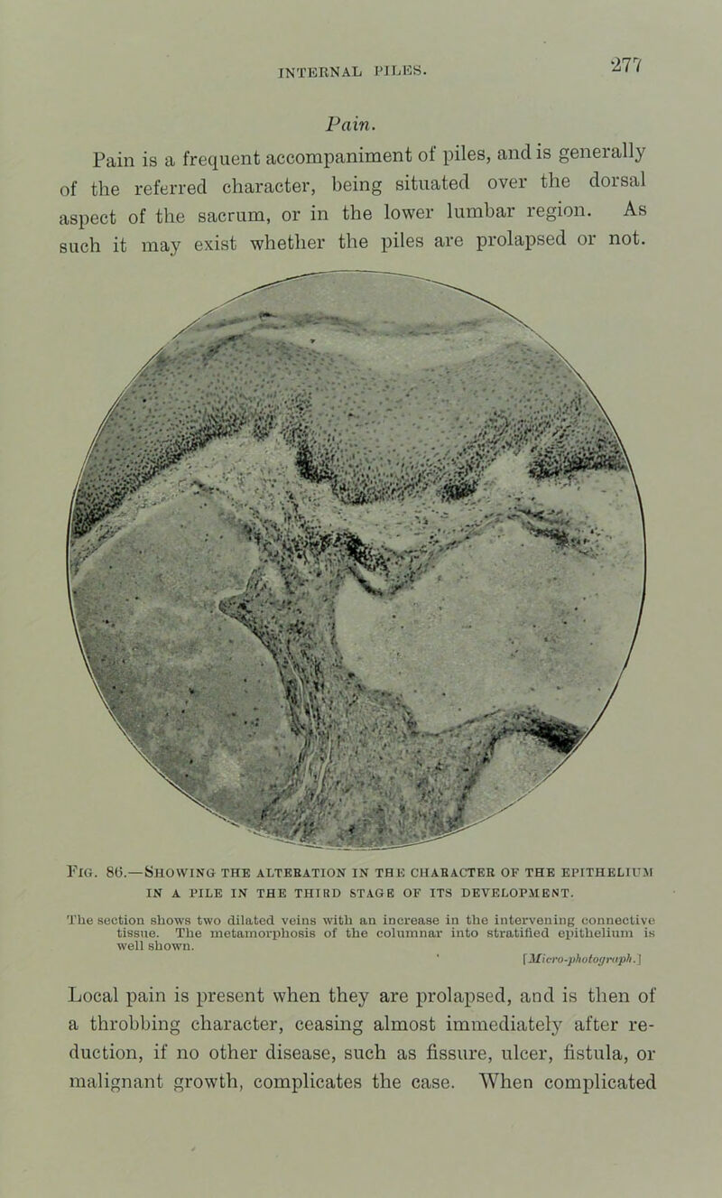Pain. Pain is a frequent accompaniment of piles, and is generally of the referred character, being situated over the dorsal aspect of the sacrum, or in the lower lumbar region. As such it may exist whether the piles are prolapsed or not. Fig. 8(3.—Showing the altebation in the chahacter of the epitheliuji IN A PILE IN THE THIRD STAGE OF ITS DEVELOPMENT. The section shows two dilated veins with an increase in the intervening connective tissue. The metamorphosis of the columnar into stratified epithelium is well show'll. \ Micro-photograph.^ Local pain is present when they are prolapsed, and is then of a throbbing character, ceasing almost immediate!}’’ after re- duction, if no other disease, such as fissure, ulcer, fistula, or malignant growth, complicates the case. When complicated