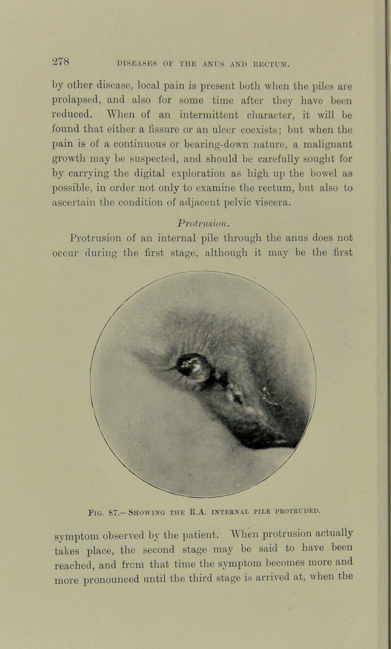 ‘278 by other disease, local pain is present both when the piles are I prolapsed, and also for some time after they have been I reduced. When of an intermittent character, it will he | found that either a fissure or an ulcer coexists; hut when the | pain is of a continuous or bearing-down nature, a malignant growth may he suspected, and should he carefully sought for by carrying the digital exploration as high up the bowel as possible, in order not only to examine the rectum, hut also to ascertain the condition of adjacent pelvic viscera. ' Protrusion. t Protrusion of an internal pile through the anus does not : occur during the first stage, although it may be the first Fig. 87.—Showing the K.A. inteknal pile pboteuued. symptom observed by the patient. When protrusion actually takes place, the second stage may be said to have been reached, and from that time the symptom becomes more and more pronounced until the third stage is arrived at, Avhen the