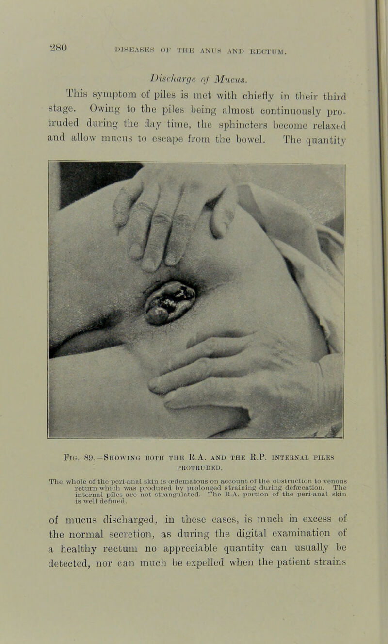 DISIOASIOS OK TilK ANI'S ANI) JfKC'J'UM. •iHO 1 >iscli(trfi(‘ nj' Mucus. This symptom of piles is met with chietiy in their third stage. Owing to the piles being almost continuously pro- truded during the day time, the si)hincters become relaxed and allow mucus to escape Irom the bowel. 4'he (juantit\’ Fig. 89.— Showing both the li.A. and the B.P. iNTEEN.eE piles PROTRUDED. The whole of the peri-anal skin is ledeinatons on account of the obstruction to venous return which was produced by prolonged straining during defsecation. The internal piles are not .strangulated. The R..V. portion of the peri-anal skin is well defined. of mucus discharged, in these cases, is much in excess of the normal secretion, as during the digital examination of a healthy rectum no apjjreciable quantity can usually be detected, nor can much be expelled when the patient strains