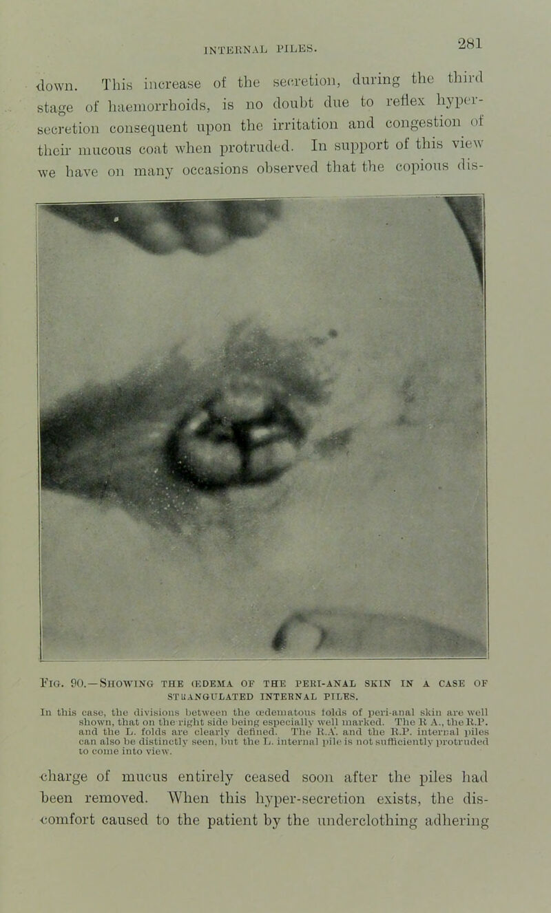 down. This increase of the secretion, during the third stage of haemorrhoids, is no douht due to reflex hyper- secretion consequent upon the irritation and congestion of their mucous coat when protruded. In support of this view w'e have on many occasions observed that the copious dis- I'lG. 90.—Showing the (Kdema of the peri-anal skin in a case of STUANGULATED INTERNAL PILES. In this case, the divisions between the a^deniatons iolds of pevi-anal skin are well shown, that on the right side being especially well marked. The K A., the It.R. and the L. folds are clearly defined. The U..V. and the R.R. internal piles can also be distinctly seen, but the L. internal pile is not sufficiently protiuided to come into view. <iharge of mucus entirely ceased soon after the piles had been removed. When this hyper-secretion exists, the dis- comfort caused to the patient by the underclothing adhering