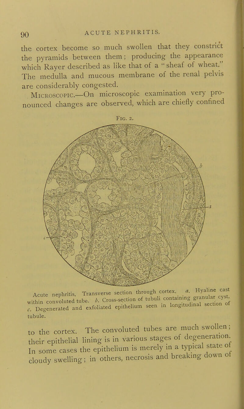 the cortex become so much swollen that they constrict the pyramids between them; producing the appearance which Rayer described as like that of a sheaf of wheat. The medulla and mucous membrane of the renal pelvis are considerably congested. Microscopic.—On microscopic examination very pro- nounced changes are observed, which are chiefly confined Fig. 2. Acute nephritis. Transverse section through cortex. a. Hyaline cast wifh n convoluted tube. ^. Cross-section of ^ubuli conta.nmg granula.^ c^^ c. Degenerated and exfoliated epithelium seen m long.tudmal section of tubule. to the cortex. The convoluted tubes are much swollen; their epithelial lining is in various stages of degeneration In some cases the epithelium is merely in a typical state of cloudy swelling; in others, necrosis and breaking down of
