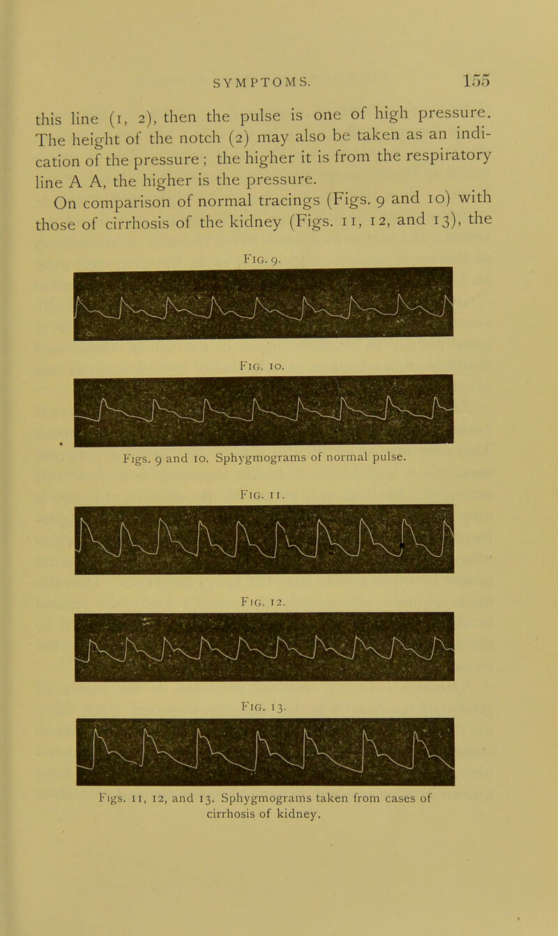 this line (i, 2), then the pulse is one of high pressure. The height of the notch (2) may also be taken as an indi- cation of the pressure ; the higher it is from the respiratory line A A, the higher is the pressure. On comparison of normal tracings (Figs. 9 and 10) with those of cirrhosis of the kidney (Figs. 11, 12, and 13), the Fig. 9. Figs. 9 and lo. Sphygniograms of normal pulse. Fig. II. Figs. II, 12, and 13. Sphygmogiams taken from cases of cirrhosis of kidney.