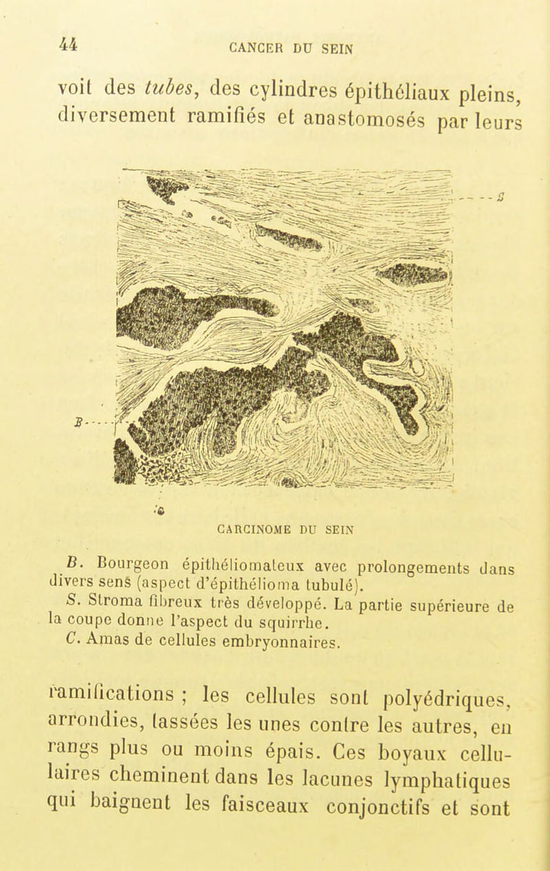 voit des tubes, des cylindres épithéliaux pleins, diversement ramifiés et anastomosés par leurs •'6 CARCINOME DU SEIN B. Bourgeon épithéliomaleux avec prolongements dans divers sens (aspect d'épithélioma tubulé), S. Stroraa fibreux très développé. La partie supérieure de la coupe donne l'aspect du squirrhe. C. Amas de cellules embryonnaires. ramifications ; les cellules sont polyédriques, arrondies, tassées les unes contre les autres, eu rangs plus ou moins épais. Ces boyaux cellu- laires cheminent dans les lacunes lymphatiques qui baignent les faisceaux conjonctifs et sont