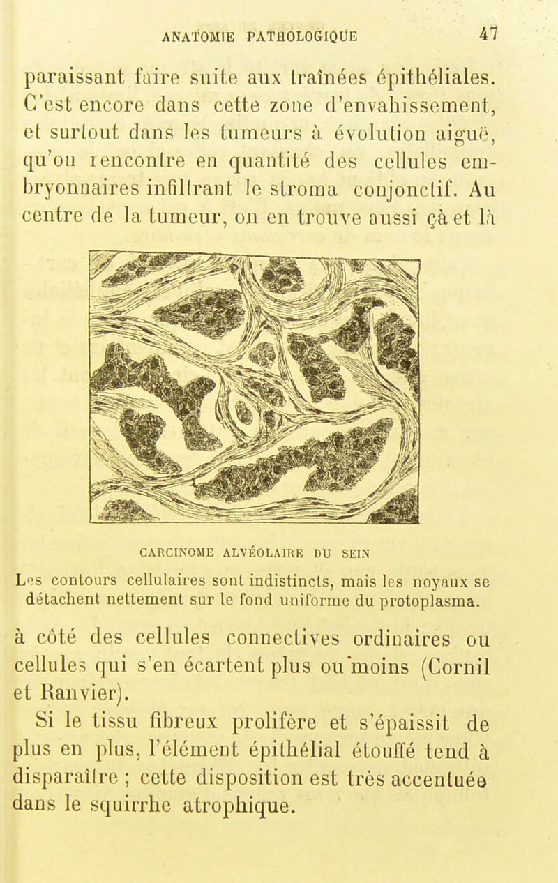 paraissant faire suite aux traînées épithéliales. C'est encore dans cette zone d'envahissement, et surtout dans les tumeurs à évolution aiguë, qu'on rencontre en quantité des cellules em- bryonnaires infiltrant le stroma conjonctif. Au centre de la tumeur, on en trouve aussi çàet là CARCINOME ALVÉOLAIRE DU SEIN Lf^s contours cellulaires sont indistincts, mais les noyaux se détachent nettement sur le fond uniforme du protoplasma. à côté des cellules connectives ordinaires ou cellules qui s'en écartent plus ou moins (Cornil et Ranvier). Si le tissu fibreux prolifère et s'épaissit de plus en plus, l'élément épithélial étouffé tend à disparaîire ; cette disposition est très accentuée dans le squirrhe atrophique.