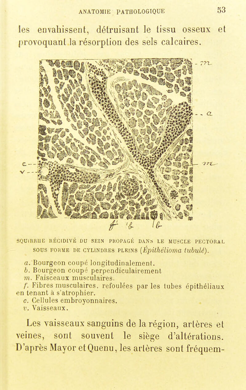 les envahissent, détruisant le tissu osseux et provoquant la résorption des sels calcaires. SQUIRRUE RÉCIDIVÉ DU SEIN PROPAGÉ DANS LE MUSCLE PECTORAL SOUS FORME DE CYLINDRES PLRiNs [ÉpithéHoma tubulé). a. Bourgeon coupé longitudinalement. b. Bourgeon coupé perpendiculairement m. Faisceaux musculaires. /'. Fibres musculaires, refoulées parles tubes épithéliaux en tenant à s'atrophier. c. Cellules embroyonnaires. V. Vaisseaux. Les vaisseaux sanguins de la région, artères et veines, sont souvent le siège d'altérations. D'après Mayor etQuenu, les artères sont fréquem-